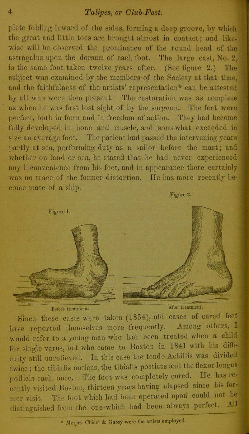 plcte folding inward of the soles, forming a deep groove, by winch the great and little toes are brought almost in contact; and like- wise will be observed the prominence of the round head of the astragalus upon the dorsum of each foot. The large cast, No. 2, is the same foot taken twelve years after. (See figure 2.) The subject was examined by the members of the Society at that time, and the faithfulness of the artists' representation* can be attested by all who were then present. The restoration was as complete as when he was first lost sight of by the surgeon. The feet were perfect, both in form and in freedom of action. They had become fully developed in bone and muscle, and somewhat exceeded in size an average foot. The patient had passed the intervening years partly at sea, performing duty as a sailor before the mast; and whether on land or sea, he stated that he had never experienced any inconvenience from his feet, and in appearance there certainly was no trace of the former distortion. He has more recently be- come mate of a ship. Figure 2. Figure 1 Before treatment. treatment. Since these casts were taken (1854), old cases of cured feet have reported themselves more frequently. Among others, I would refer to a young man who had been treated when a child for single varus, but who came to Boston in 1841 with his diffi- culty still unrelieved. In this case the tendo-Achillis was divided twice ; the tibialis anticus, the tibialis posticus and the flexor longus pollicis each, once. The foot was completely cured. He has re cently visited Boston, thirteen years having elapsed since his for iner visit. The foot which had been operated upon could not be distinguished from the one which had been always perfect. All * Messrs. Chicei & Garey were the artists employed.