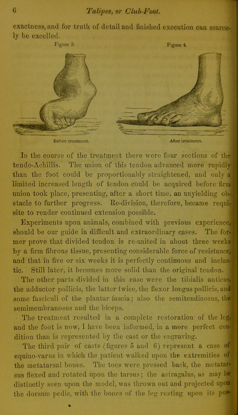 exactness, and for truth of detail and finished execution can scarce- ly be excelled. Figure 3. Figure 4. Before treatment. After treatment. In the course of the treatment there were four sections of thq tendo-Achillis. The union of this tendon advanced more rapidly than the foot could be proportionally straightened, and only x limited increased length of tendon could be acquired before-linn; union took place, presenting, after a short time, an unyielding obi stacle to further progress. Re-division, therefore, became requi* site to render continued extension possible. Experiments upon animals, combined with previous experience! should be our guide in difficult and extraordinary cases. The for-* mer prove that divided tendon is re-united in about three weeks: by a firm fibrous tissue, presenting considerable force of resistance* and that in five or six weeks it is perfectly continuous and inelas-i tic. Still later, it becomes more solid than the original teudon. ; The other parts divided in this case were the tibialis anticua the adductor pollicis, the latter twice, the flexor longus pollicis. and some fasciculi of the plantar fascia; also the semitendinous, the semimembranosus and the biceps. • The treatment resulted in a complete restoration of the lcg^ and the foot is now, I have been informed, in a more perfect com dition than is represented by the cast or the engraving. The third pair of casts (figures 5 and 6) represent a case of equino-varus in which the patient walked upon the extremities of the metatarsal bones. The toes were pressed back, the md atari sus flexed and rotated upon the tarsus; the astragalus, as maybe distinctly seen upon the model, was thrown out and projected upon the dorsum pedis, with the bones of the leg resting upon its pos»