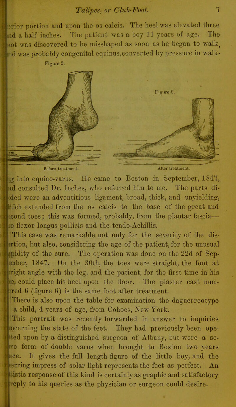 ■ prior portion and upon the os calcis. The heel was elevated three IInd a half inches. The patient was a boy 11 years of age. The 1 Lot was discovered to be misshaped as soon as he began to walk; I id was probably congenital equinus, converted by pressure in walk- Figure 5. Before treatment. After treatment. |.g into equino-varus. He came to Boston in September, 1847, id consulted Dr. Inches, who referred him to me. The parts di- !'. ded were an adventitious ligament, broad, thick, and unyielding, laich extended from the os calcis to the base of the great and licond toes; this was formed, probably, from the plantar fascia,— Ice flexor longus pollicis and the tendo-Achillis. \ This case was remarkable not only for the severity of the dis- Irrtion, but also, considering the age of the patient, for the unusual Jipidity of the cure. The operation was done on the 22d of Sep- limber, 1847. On the 30th, the toes were straight, the foot at Jrpight angle with the leg, and the patient, for the first time in his tee, could place hi° heel upon the floor. The plaster cast num- Irred 6 (figure 6) is the same foot after treatment, r There is also upoD the table for examination the daguerreotype a child, 4 years of age, from Cohoes, New York. ■'This portrait was recently forwarded in answer to inquiries lincerning the state of the feet. They had previously been ope- ned upon by a distinguished surgeon of Albany, but were a se- irre form of double varus when brought to Boston two years [lice. It gives the full length figure of the little boy, and the fprring impress of solar light represents the feet as perfect. An ■dstic response of this kind is certainly as graphic and satisfactory r*eply to his queries as the physician or surgeon could desire.