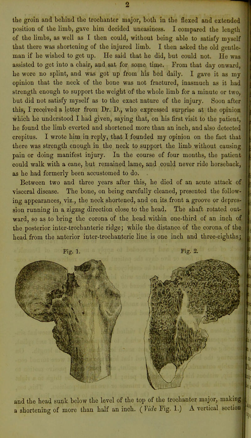 position of the limb, gave him decided uneasiness. I compared the length of the limbs, as well as I then could, without being able to satisfy myself that there was shortening of the injured limb. I then asked the old gentle- man if he wished to get up. He said that he did, but could not. He was assisted to get into a chair, and sat for some time. From that day onward, he wore no splint, and was got up from his bed daily. I gave it as my opinion that the neck of the bone was not fractured, inasmuch as it had strength enough to support the weight of the whole limb for a minute or two, but did not satisfy myself as to the exact nature of the injury. Soon after this, I received a letter from Dr. D., who expressed surprise at the opinion which he understood I had given, saying that, on his first visit to the patient, he found the limb everted and shortened more than an inch, and also detected crepitus. I wrote him in reply, that I founded my opinion on the fact that there was strength enough in the neck to support the limb without causing pain or doing manifest injury. In the course of four months, the patient could walk with a cane, but remained lame, and could never ride horseback, as he had formerly been accustomed to do. Between two and three years after this, he died of an acute attack of visceral disease. The bone, on being carefully cleaned, presented the follow- ing appearances, viz., the neck shortened, and on its front a groove or depres- sion running in a zigzag direction close to the head. The shaft rotated out- ward, so as to bring the corona of the head within one-third of an inch of the posterior inter-trochanteric ridge; while the distance of the corona of the head from the anterior inter-trochanteric line is one inch and three-eighths; Fig. 1. Fig. 2. and the head sunk below the level of the top of the trochanter major, makin a shortening of more than half an inch. (Vide Fig. 1.) A vertical sectio