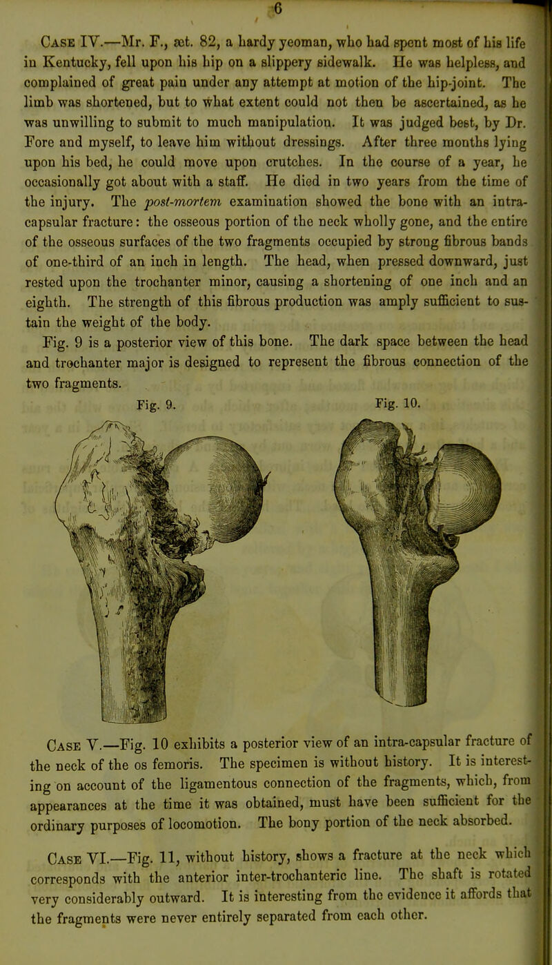 G Case IV.—Mr. F., act. 82, a Lardy yeomaD, who bad spent most of his life in Kentucky, fell upon his hip on a slippery sidewalk. He was helpless, and complained of great pain under any attempt at motion of the hip-joint. The limb was shortened, but to what extent could not then be ascertained, as he was unwilling to submit to much manipulation. It was judged best, by Dr. Fore and myself, to leave him without dressings. After three months lying upon his bed, he could move upon crutches. In the course of a year, he occasionally got about with a staff. He died in two years from the time of the injury. The post-mortem examination showed the bone with an intra- capsular fracture: the osseous portion of the neck wholly gone, and the entire of the osseous surfaces of the two fragments occupied by strong fibrous bands of one-third of an inch in length. The head, when pressed downward, just rested upon the trochanter minor, causing a shortening of one inch and an eighth. The strength of this fibrous production was amply sufficient to sus- tain the weight of the body. Fig. 9 is a posterior view of this bone. The dark space between the head and trochanter major is designed to represent the fibrous connection of the two fragments. Fig. 9. Fig. 10. Case V.—Fig. 10 exhibits a posterior view of an intra-capsular fracture of the neck of the os femoris. The specimen is without history. It is interest- ing on account of the ligamentous connection of the fragments, which, from appearances at the time it was obtained, must have been sufficient for the ordinary purposes of locomotion. The bony portion of the neck absorbed. Case VI.—Fig. 11, without history, shows a fracture at the neck which corresponds with the anterior inter-trochanteric line. The shaft is rotated very considerably outward. It is interesting from the evidence it affords that the fragments were never entirely separated from each other.