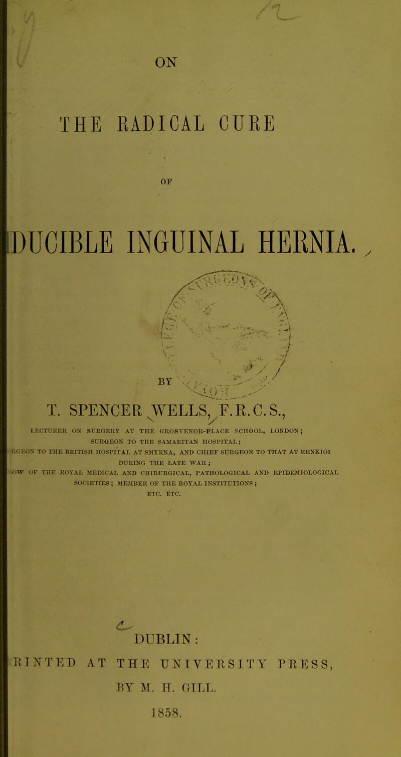 THE ON RADICAL CURE OF DUCIBLE INGUINAL HERNIA >* j A . -.1 a. 9 ■! 7 J5i BY T. SPENCER WELLS, F.R.C.S., LECTURER ON SURGERY AT THE GROS VENOR-PLACE SCHOOL, LONDON; SURGEON TO THE SAMARITAN HOSPITAL; RQBON TO THE BRITISH HOSPITAL AT SMYRNA, AND CHIEF SURGEON TO THAT AT RENKIOI DURING THE LATE WAR ; X)W OF THE ROYAL MEDICAL AND CH1RCRGICAL, PATHOLOGICAL AND EPIDEMIOLOGICAL SOCIETIES; MEMBER OF THE ROYAL INSTITUTIONS; ETC. ETC. DUBLI N : R IN TED AT THE UNIVERSITY PRESS, m M. IT. GILL. 1858,