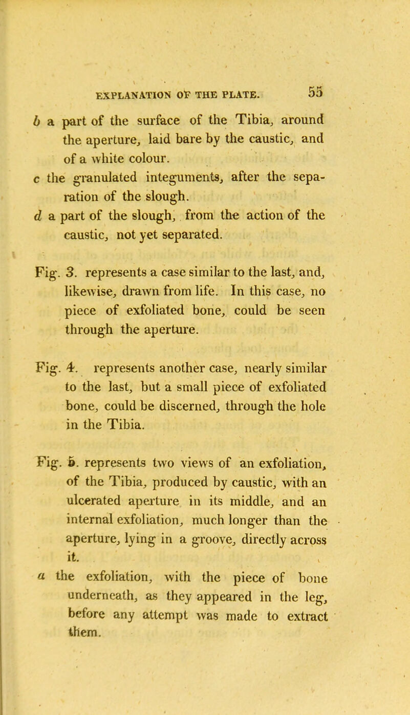 b a part of the surface of the Tibia, around the aperture, laid bare by the caustic, and of a white colour. c the granulated integuments, after the sepa- ration of the slough. d a part of the slough, from the action of the caustic, not yet separated. Fig. 3. represents a case similar to the last, and, likewise, drawn from life. In this case, no piece of exfoliated bone, could be seen through the aperture. Fig. 4. represents another case, nearly similar to the last, but a small piece of exfoliated bone, could be discerned, through the hole in the Tibia. Fig. 5. represents two views of an exfoliation, of the Tibia, produced by caustic, with an ulcerated aperture in its middle, and an internal exfoliation, much longer than the aperture, lying in a groove, directly across it. a the exfoliation, with the piece of bone underneath, as they appeared in the leg, before any attempt was made to extract them.