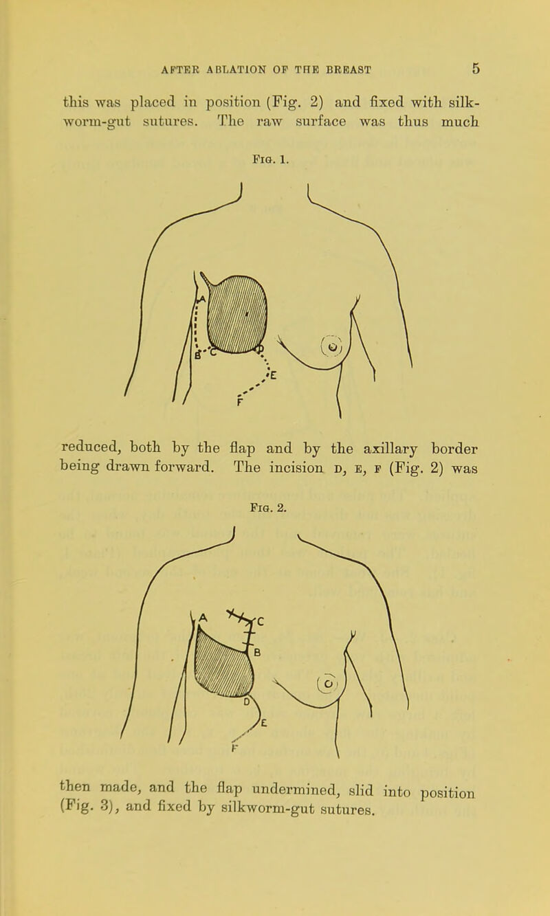 this was placed in position (Fig. 2) and fixed with silk- worm-gut sutures. The raw surface was thus much Fig. 1. reduced, both by the flap and by the axillary border being drawn forward. The incision D, E, F (Fig. 2) was PiQ. 2. then made, and the flap undermined, slid into positi (Fig. 3), and fixed by silkworm-gut sutures.
