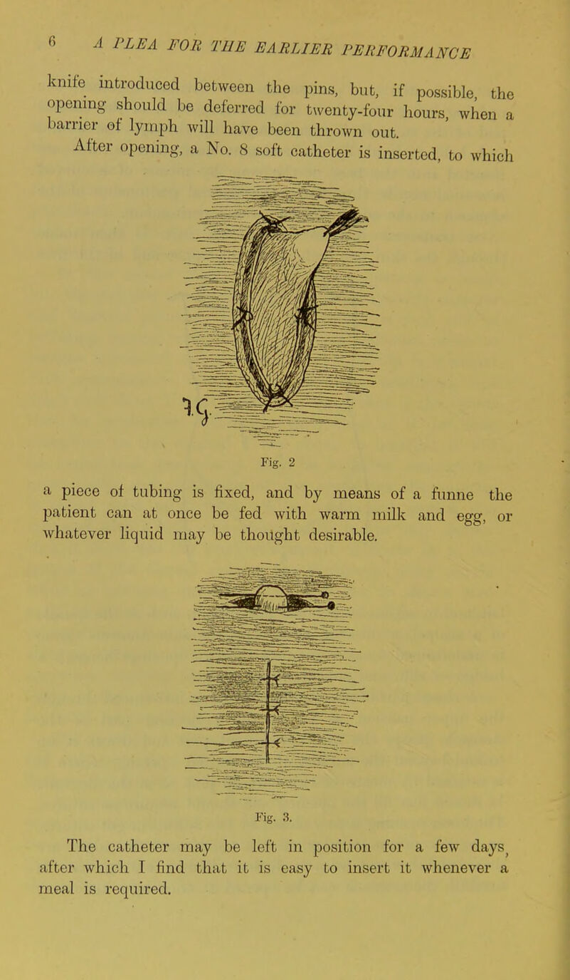 knife introduced between the pins, but, if possible, the opening should be deferred for twenty-four hours, when a barrier of lymph will have been thrown out. After opening, a No. 8 soft catheter is inserted, to which Fig. 2 a piece of tubing is fixed, and by means of a funne the patient can at once be fed with warm milk and egg, or whatever liquid may be thought desirable. Fig. 3. The catheter may be left in position for a few days^ after which I find that it is easy to insert it whenever a meal is required.