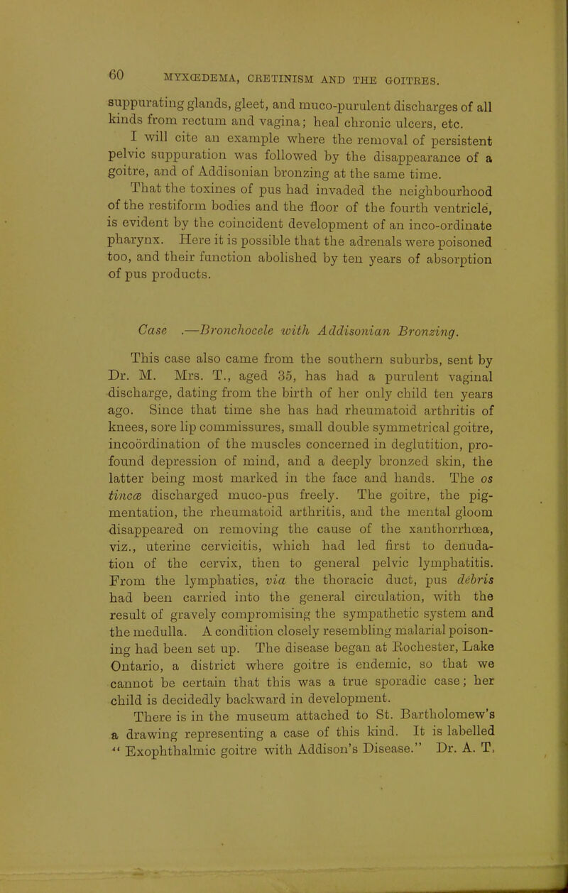 suppurating glands, gleet, and muco-purulent discharges of all kinds from rectum and vagina; heal chronic ulcers, etc. I will cite an example where the removal of persistent pelvic suppuration was followed by the disappearance of a goitre, and of Addisonian bronzing at the same time. That the toxines of pus had invaded the neighbourhood of the restiform bodies and the floor of the fourth ventricle, is evident by the coincident development of an inco-ordinate pharynx. Here it is possible that the adrenals were poisoned too, and their function abolished by ten years of absorption of pus products. Case .—Bronchocele with Addisonian Bronzing. This case also came from the southern suburbs, sent by Dr. M. Mrs. T., aged 35, has had a purulent vaginal discharge, dating from the birth of her only child ten years ago. Since that time she has had rheumatoid arthritis of knees, sore lip commissures, small double symmetrical goitre, incoordination of the muscles concerned in deglutition, pro- found depression of mind, and a deeply bronzed skin, the latter being most marked in the face and hands. The os tinea discharged muco-pus freely. The goitre, the pig- mentation, the rheumatoid arthritis, and the mental gloom disappeared on removing the cause of the xanthorrhoea, viz., uterine cervicitis, which had led first to denuda- tion of the cervix, then to general pelvic lymphatitis. From the lymphatics, via the thoracic duct, pus debris had been carried into the general circulation, with the result of gravely compromising the sympathetic system and the medulla. A condition closely resembling malarial poison- ing had been set up. The disease began at Rochester, Lake Ontario, a district where goitre is endemic, so that we cannot be certain that this was a true sporadic case; her child is decidedly backward in development. There is in the museum attached to St. Bartholomew's a drawing representing a case of this kind. It is labelled 4i Exophthalmic goitre with Addison's Disease. Dr. A. T,