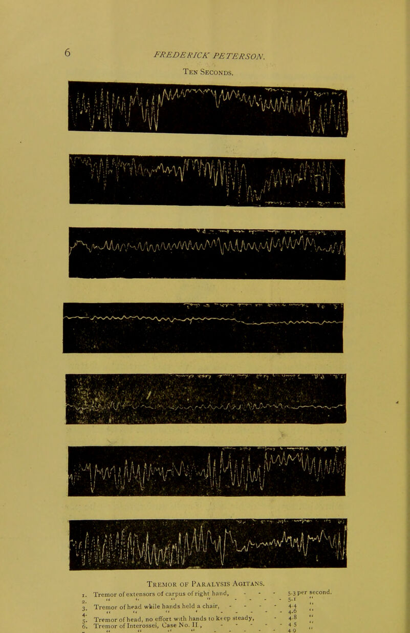 FREDEl\ K 'A PETERSON. Ten Seconds. ■ f I w ... ~r»---v — v -' 1- »~V 1 l' .TY»-'t ' V 3 ■ > /Xwi ft-#\ v- Mi p. ■ y : ■ . ■ /' ■ : »J '* : /i i*i I; /' > ii ', ii 1 Mi. Tremor of Paralysis Agitans. i. Tremor of extensors of carpus of right hand. 2. Tremor of head while hands held a chair, 5! Tremor of head, no effort with hands to ki ep steady, 6. TremorofInterossei.CaseNo.il, 5.3 per second. 5-1 4-4 4.6 4.8 4 5