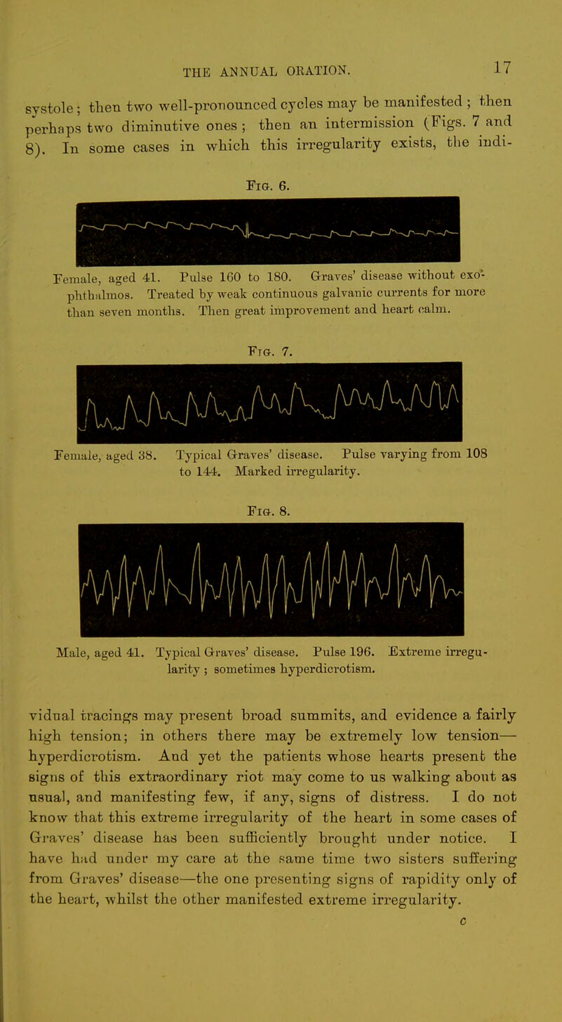 systole; then two well-pronounced cycles may be manifested ; then perhaps two diminutive ones ; then an intermission (Figs. 7 and 8). In some cases in which this irregularity exists, the indi- FiG. 6. Female, aged 41. Pulse 160 to 180. Graves' disease without exo- phthalmos. Treated by weak continuous galvanic currents for more than seven months. Then great improvement and heart calm. Female, aged 38. Typical Grraves' disease. Pulse varying from 108 to 144. Marked irregularity. Fi&. 8. Male, aged 41. Typical Graves' disease. Pulse 196. Extreme irregu- larity ; sometimes hyperdicrotism. vidual tracings may present broad summits, and evidence a fairly high tension; in others there may be extremely low tension— hyperdicrotism. And yet the patients whose hearts present the signs of this extraordinary riot may come to us walking about as usual, and manifesting few, if any, signs of distress. I do not know that this extreme irregularity of the heart in some cases of Graves' disease has been sufficiently brought under notice. I have had under my care at the same time two sisters suffering from Graves' disease—the one presenting signs of rapidity only of the heart, whilst the other manifested extreme irregularity. c