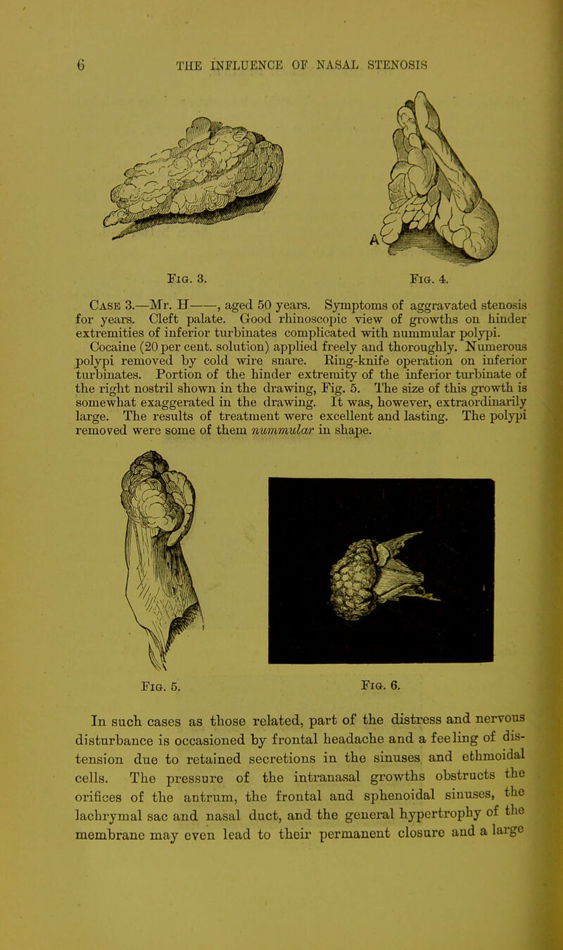 Case 3.—Mr. H , aged 50 years. Symptoms of aggravated stenosis for years. Cleft palate. Good rhinoscopic view of growths on hinder extremities of inferior turbinates complicated with nummular polypi. Cocaine (20 per cent, solution) applied freely and thoroughly. Numerous polypi removed by cold wire snare. Ring-knife operation on inferior turbinates. Portion of the hinder extremity of the inferior turbinate of the right nostril shown in the drawing, Fig. 5. The size of this growth is somewhat exaggerated in the drawing. It was, however, extraordinarily large. The results of treatment were excellent and lasting. The polypi removed were some of them nummular in shape. Fig. 5. Fig. 6. In such cases as those related, part of the distress and nervous disturbance is occasioned by frontal headache and a feeling of dis- tension due to retained secretions in the sinuses and ethmoidal cells. The pressure of the intranasal growths obstructs the orifices of the antrum, the frontal and sphenoidal sinuses, the lachrymal sac and nasal duct, and the general hypertrophy of the membrane may even lead to their permanent closure and a large