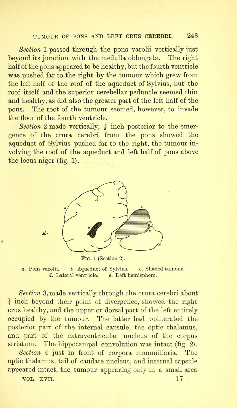 Section 1 passed through the pons varolii vertically just beyond its junction with the medulla oblongata. The right half of the pons appeared to be healthy, but the fourth ventricle was pushed far to the right by the tumour which grew from the left half of the roof of the aqueduct of Sylvius, but the roof itself and the superior cerebellar peduncle seemed thin and healthy, as did also the greater part of the left half of the pons. The root of the tumour seemed, however, to invade the floor of the fourth ventricle. Section 2 made vertically, J inch posterior to the emer- gence of the crura cerebri from the pons showed the aqueduct of Sylvius pushed far to the right, the tumour in- volving the roof of the aqueduct and left half of pons above the locus niger (fig. 1). a. Pons varolii. b. Aqueduct of Sylvius. c. Shaded tumour. d. Lateral ventricle. e. Left hemisphere. Section 3, made vertically through the crura cerebri about J inch beyond their point of divergence, showed the right crus healthy, and the upper or dorsal part of the left entirely occupied by the tumour. The latter had obliterated the posterior part of the internal capsule, the optic thalamus, and part of the extraventricular nucleus of the corpus striatum. The hippocampal convolution was intact (fig. 2). Section 4 just in front of corpora mammillaria. The optic thalamus, tail of caudate nucleus, and internal capsule appeared intact, the tumour appearing only in a small area