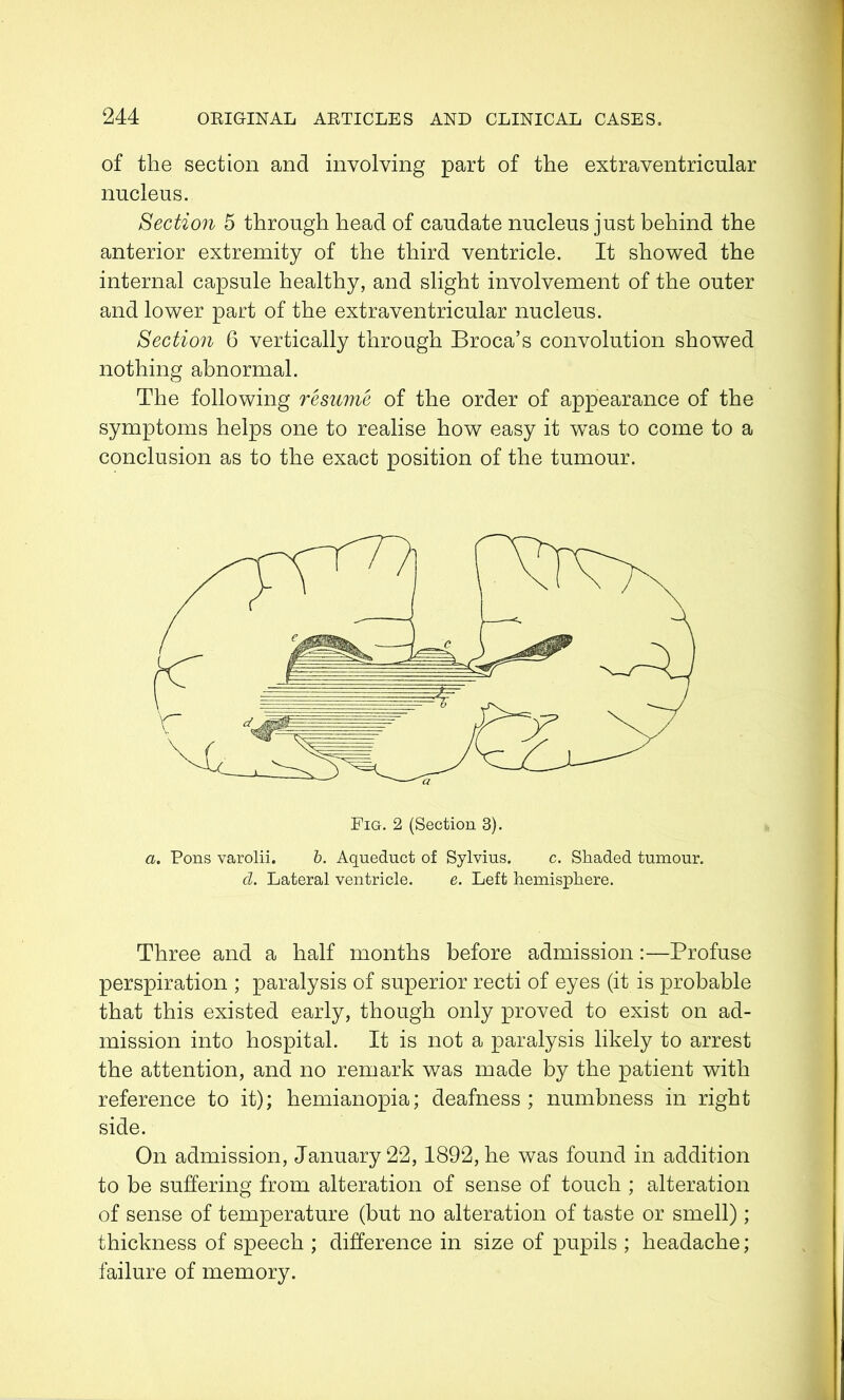 of the section and involving part of the extraventricular nucleus. Section 5 through head of caudate nucleus just behind the anterior extremity of the third ventricle. It showed the internal capsule healthy, and slight involvement of the outer and lower part of the extraventricular nucleus. Section 6 vertically through Broca’s convolution showed nothing abnormal. The following resume of the order of appearance of the symptoms helps one to realise how easy it was to come to a conclusion as to the exact position of the tumour. a. Pons varolii. b. Aqueduct of Sylvius. c. Shaded tumour. d. Lateral ventricle. e. Left hemisphere. Three and a half months before admission:—Profuse perspiration ; paralysis of superior recti of eyes (it is probable that this existed early, though only proved to exist on ad- mission into hospital. It is not a paralysis likely to arrest the attention, and no remark was made by the patient with reference to it); hemianopia; deafness; numbness in right side. On admission, January 22,1892, he was found in addition to be suffering from alteration of sense of touch ; alteration of sense of temperature (but no alteration of taste or smell); thickness of speech ; difference in size of pupils ; headache; failure of memory.