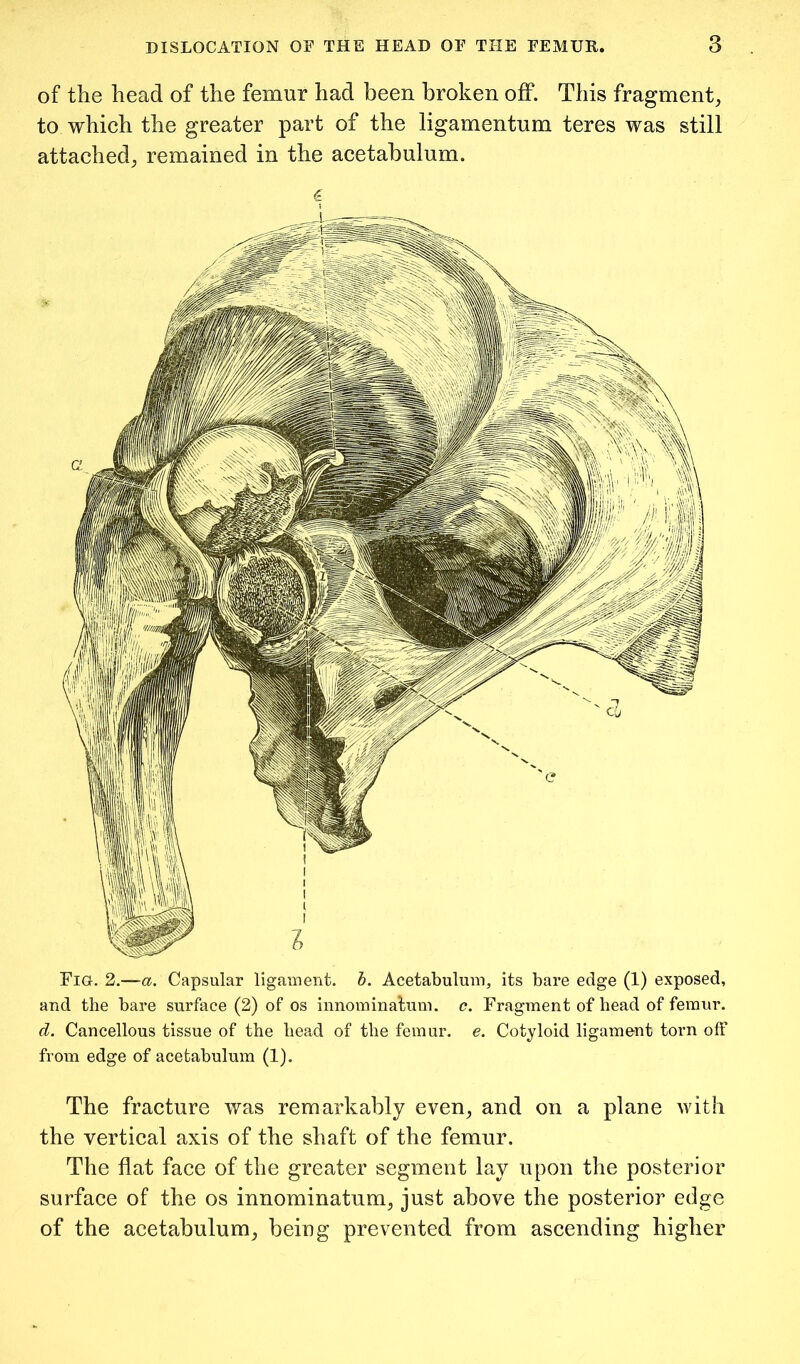 of the head of the femur had been broken oflP. This fragment, to which the greater part of the ligamentum teres was still attached, remained in the acetabulum. Fig. 2.—a. Capsular ligament, h. Acetabulum, its bare edge (1) exposed, and the bare surface (2) of os innominatum. c. Fragment of bead of femur. d. Cancellous tissue of the head of the femur, e. Cotyloid ligament torn off from edge of acetabulum (1). The fracture was remarkably even, and on a plane with the vertical axis of the shaft of the femur. The flat face of the greater segment lay upon the posterior surface of the os innominatum, just above the posterior edge of the acetabulum, being prevented from ascending higher