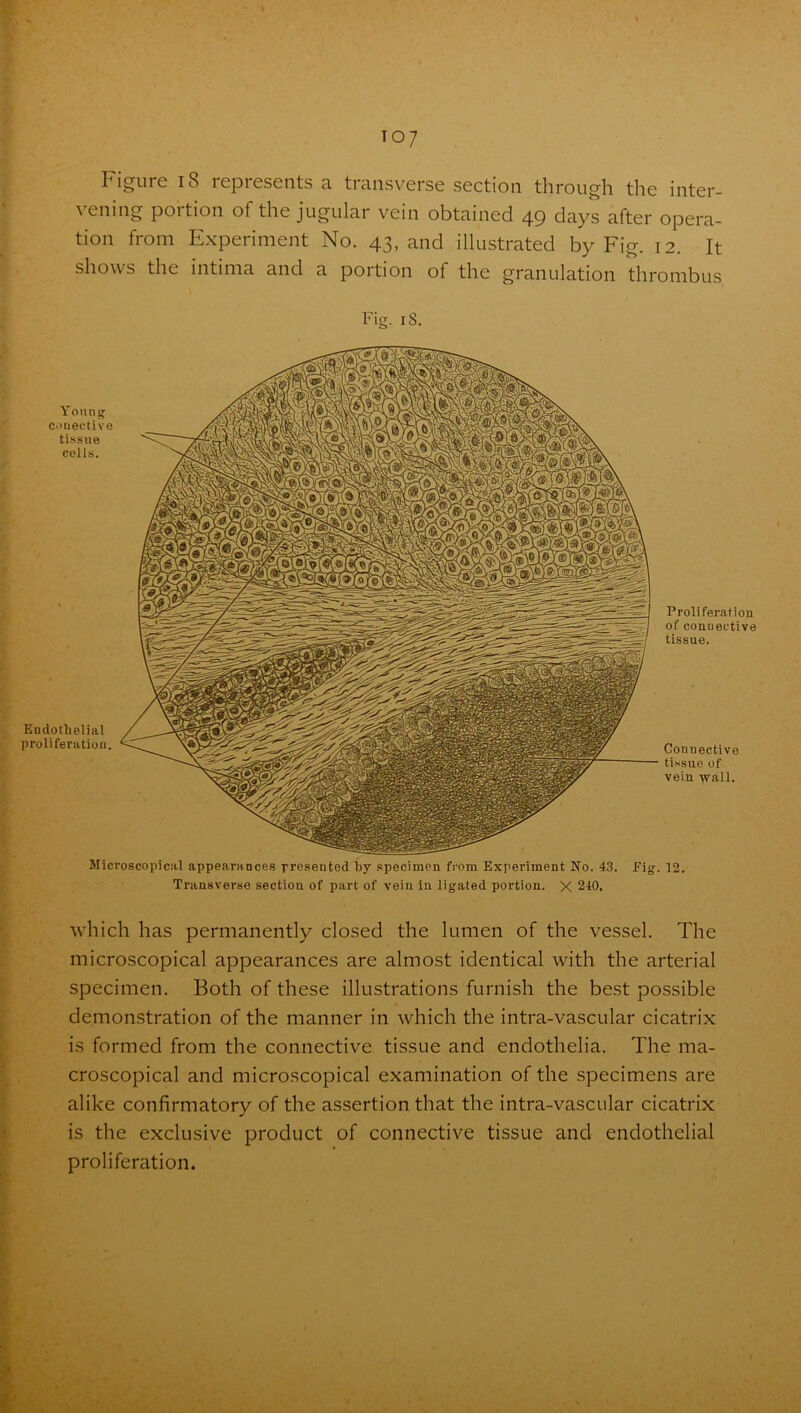 T°7 Figure 18 represents a transverse section through the inter- vening poition of tilt, jugular vein obtained 49 days after opera- tion from Experiment No. 43, and illustrated by Fig. 12. It shows the intima and a portion of the granulation thrombus Fig. iS. Young c.>uective tissue cells. Endothelial proliferation. Proliferation of connective tissue. Connective tissue of vein wall. Microscopical appearances presented by specimen from Experiment No. 43. Pig. 12. Transverse section of part of vein in ligated portion. X 240. which has permanently closed the lumen of the vessel. The microscopical appearances are almost identical with the arterial specimen. Both of these illustrations furnish the best possible demonstration of the manner in which the intra-vascular cicatrix is formed from the connective tissue and endothelia. The ma- croscopical and microscopical examination of the specimens are alike confirmatory of the assertion that the intra-vascular cicatrix is the exclusive product of connective tissue and endothelial proliferation.