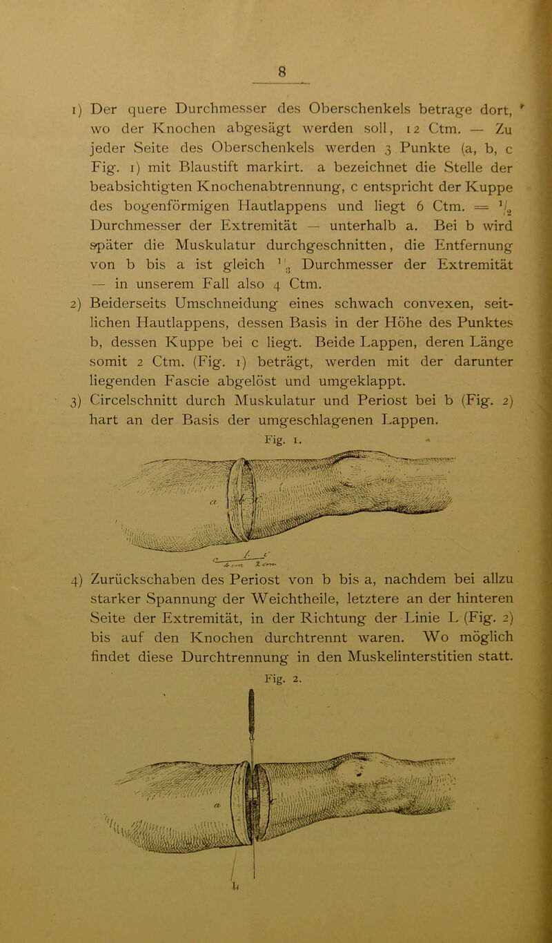 1) Der quere Durchmesser des Oberschenkels betrage dort, wo der Knochen abgesägt werden soll, 12 Ctm. — Zu jeder Seite des Oberschenkels werden 3 Punkte (a, b, c Fig. i) mit Blaustift markirt. a bezeichnet die Stelle der beabsichtigten Knochenabtrennung, c entspricht der Kuppe des bogenförmigen Hautlappens und liegt 6 Ctm, = Durchmesser der Extremität — unterhalb a. Bei b wird später die Muskulatur durchgeschnitten, die Entfernung von b bis a ist gleich ’ '.j Durchmesser der Extremität — in unserem Fall also 4 Ctm. 2) Beiderseits Umschneidung eines schwach convexen, seit- lichen Hautlappens, dessen Basis in der Höhe des Punktes b, dessen Kuppe bei c liegt. Beide Lappen, deren Länge somit 2 Ctm. (Fig. i) beträgt, werden mit der darunter liegenden Fascie abgelöst und umgeklappt. 3) Circelschnitt durch Muskulatur und Periost bei b (Fig. 2) hart an der Basis der umgeschlagenen Lappen. Fig. I. 4) Zurückschaben des Periost von b bis a, nachdem bei allzu starker Spannung der Weichtheile, letztere an der hinteren Seite der Extremität, in der Richtung der Linie L (Fig. 2) bis auf den Knochen durchtrennt waren. Wo möglich findet diese Durchtrennung in den Muskelinterstitien statt. Fig. 2.