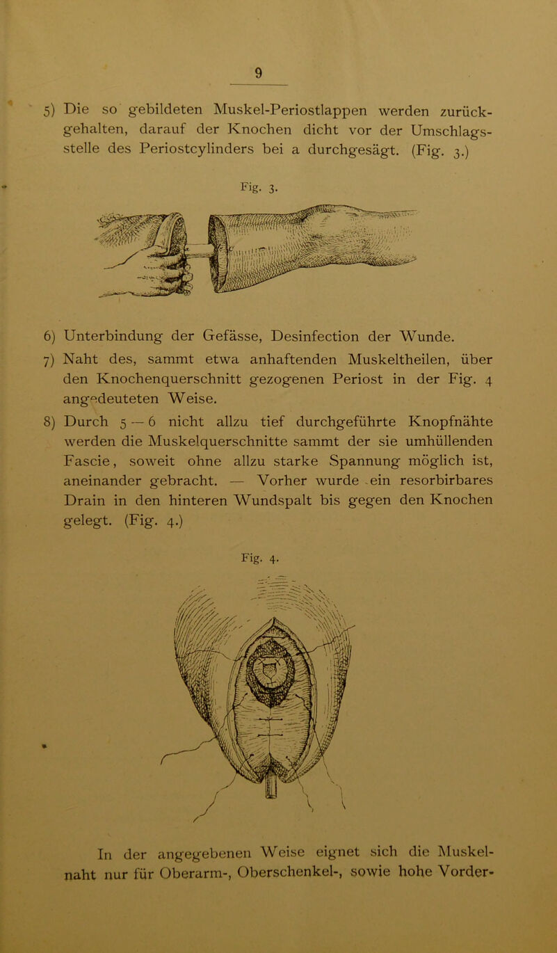 5) Die so gebildeten Muskel-Periostlappen werden zurück- gehalten, darauf der Knochen dicht vor der Umschlags- stelle des Periostcylinders bei a durchgesägt. (Fig. 3.) Fig. 3. 6) Unterbindung der Gefässe, Desinfection der Wunde. 7) Naht des, sammt etwa anhaftenden Muskeltheilen, über den Knochenquerschnitt gezogenen Periost in der Fig. 4 angedeuteten Weise. 8) Durch 5 6 nicht allzu tief durchgeführte Knopfnähte werden die Muskelquerschnitte sammt der sie umhüllenden Fascie, soweit ohne allzu starke Spannung möglich ist, aneinander gebracht. — Vorher wurde ~ein resorbirbares Drain in den hinteren Wundspalt bis gegen den Knochen gelegt. (Fig. 4.) Fig. 4. In der angegebenen Weise eignet sich die IMuskel- naht nur für Oberarm-, Oberschenkel-, sowie hohe Vorder-