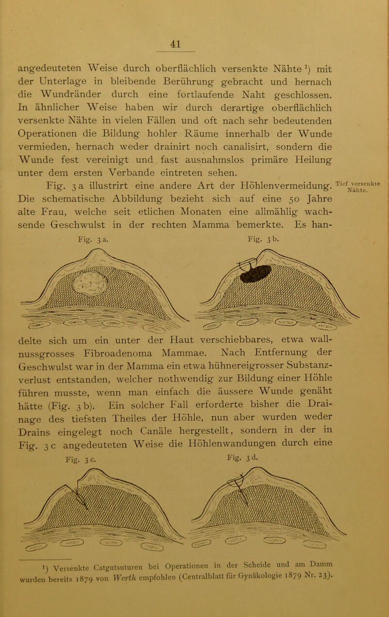 angedeuteten Weise durch oberflächlich versenkte Nähte 5) mit der Unterlage in bleibende Berührung gebracht und hernach die Wundränder durch eine fortlaufende Naht geschlossen. In ähnlicher Weise haben wir durch derartige oberflächlich versenkte Nähte in vielen Fällen und oft nach sehr bedeutenden Operationen die Bildung hohler Räume innerhalb der Wunde vermieden, hernach weder drainirt noch canalisirt, sondern die Wunde fest vereinigt und fast ausnahmslos primäre Heilung unter dem ersten Verbände eintreten sehen. Fig. 3 a illustrirt eine andere Art der Höhlenvermeidung. TiefNä^ts,?nkte Die schematische Abbildung bezieht sich auf eine 50 Jahre alte Frau, welche seit etlichen Monaten eine allmählig wach- sende Geschwulst in der rechten Mamma bemerkte. Es han- Fig. 3 a. Fig. 3 b. delte sich um ein unter der Haut verschiebbares, etwa wall- nussgrosses Fibroadenoma Mammae. Nach Entfernung der Geschwulst war in der Mamma ein etwa hühnereigrosser Substanz- verlust entstanden, welcher nothwendig zur Bildung einer Höhle führen musste, wenn man einfach die äussere Wunde genäht hätte (Fig. 3 b). Ein solcher Fall erforderte bisher die Drai- nage des tiefsten Theiles der Höhle, nun aber wurden weder Drains eingelegt noch Canäle hergestellt, sondern in der in Fig. 3 c angedeuteten Weise die Höhlen Wandungen durch eine Fig. 3 c. Fig- 3 d. J) Versenkte Catgutsuturen bei Operationen in der Scheide und am Damm wurden bereits 1879 von Werth empfohlen (Centralblatt für Gynäkologie 1879 Nr. 23).