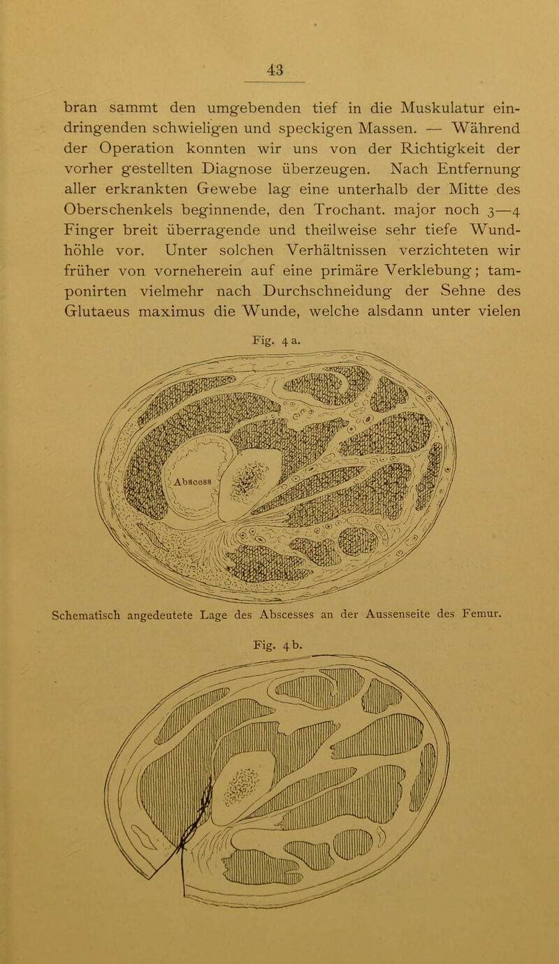 bran sammt den umgebenden tief in die Muskulatur ein- dringenden schwieligen und speckigen Massen. — Während der Operation konnten wir uns von der Richtigkeit der vorher gestellten Diagnose überzeugen. Nach Entfernung aller erkrankten Gewebe lag eine unterhalb der Mitte des Oberschenkels beginnende, den Trochant. major noch 3—4 Finger breit überragende und theilweise sehr tiefe Wund- höhle vor. Unter solchen Verhältnissen verzichteten wir früher von vorneherein auf eine primäre Verklebung; tam- ponirten vielmehr nach Durchschneidung der Sehne des Glutaeus maximus die Wunde, welche alsdann unter vielen Fig. 4 a. Schematisch angedeutete Lage des Abscesses an der Aussenseite des Femur.