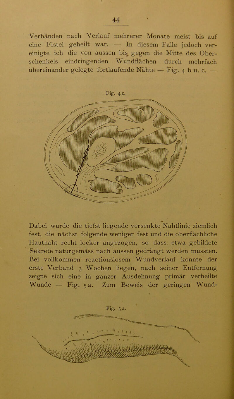 Verbänden nach Verlauf mehrerer Monate meist bis auf eine Fistel geheilt war. — In diesem Falle jedoch ver- einigte ich die von aussen bi^ gegen die Mitte des Ober- schenkels eindringenden Wundflächen durch mehrfach übereinander gelegte fortlaufende Nähte — Fig. 4 b u. c. — Fig. 4 c. Dabei wurde die tiefst liegende versenkte Nahtlinie ziemlich fest, die nächst folgende weniger fest und die oberflächliche Hautnaht recht locker angezogen, so dass etwa gebildete Sekrete naturgemäss nach aussen gedrängt werden mussten. Bei vollkommen reactionslosem Wundverlauf konnte der erste Verband 3 Wochen liegen, nach seiner Entfernung zeigte sich eine in ganzer Ausdehnung primär verheilte Wunde — Fig. 5 a. Zum Beweis der geringen Wund-