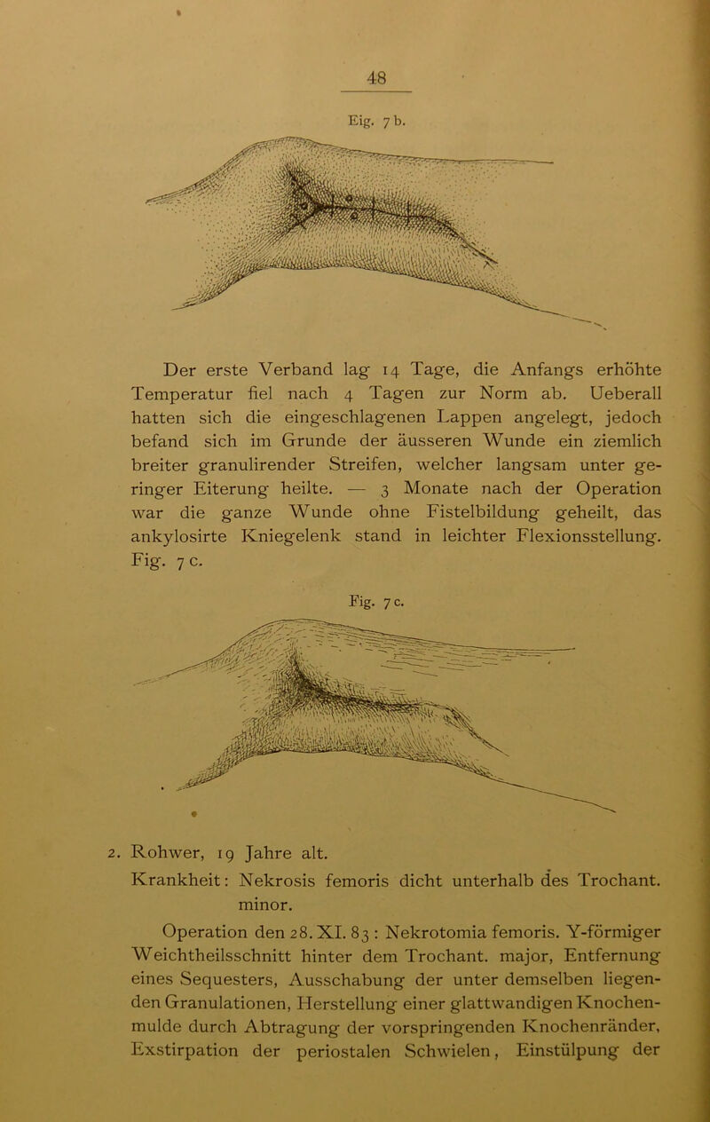 ft 48 Eig. 7 b. Der erste Verband lag 14 Tage, die Anfangs erhöhte Temperatur fiel nach 4 Tag'en zur Norm ab. Ueberall hatten sich die eingeschlagenen Lappen angelegt, jedoch befand sich im Grunde der äusseren Wunde ein ziemlich breiter granulirender Streifen, welcher langsam unter ge- ringer Eiterung heilte. — 3 Monate nach der Operation war die ganze Wunde ohne Fistelbildung geheilt, das ankylosirte Kniegelenk stand in leichter Flexionsstellung. Fig. 7 c. Fig. 7 c. 2. Rohwer, 19 Jahre alt. Krankheit: Nekrosis femoris dicht unterhalb des Trochant. minor. Operation den 28. XL 83 : Nekrotomia femoris. Y-förmiger Weichtheilsschnitt hinter dem Trochant. major, Entfernung eines Sequesters, Ausschabung der unter demselben liegen- den Granulationen, LIerstellung einer glattwandigen Knochen- mulde durch Abtragung der vorspringenden Knochenränder, Exstirpation der periostalen Schwielen, Einstülpung der
