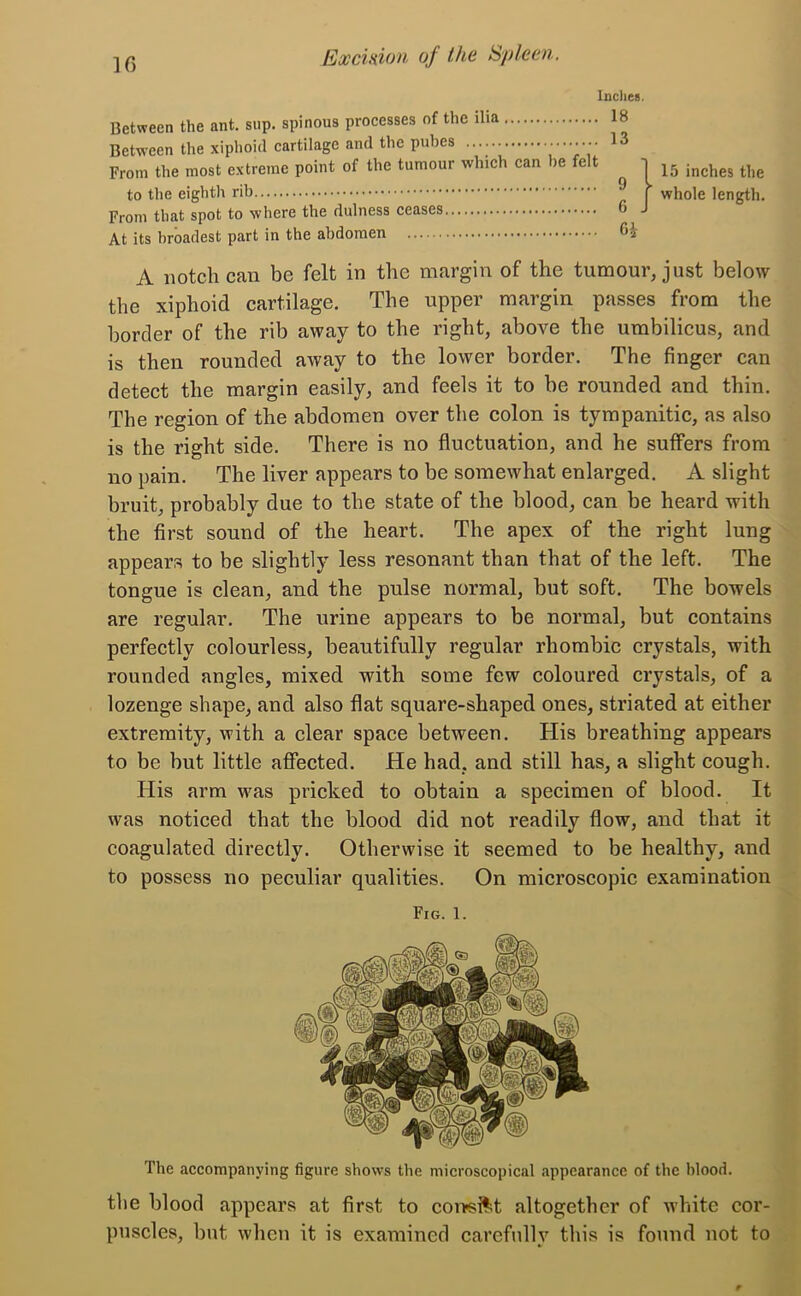 Between the ant. sup. spinous processes of the ilia 18 Between the xiphoid cartilage and the pubes 13 From the most extreme point of the tumour which can he felt From that spot to where the dulness ceases At its broadest part in the abdomen A notch can be felt in the margin of the tumour, just below the xiphoid cartilage. The upper margin passes from the border of the rib away to the right, above the umbilicus, and is then rounded away to the lower border. The finger can detect the margin easily, and feels it to be rounded and thin. The region of the abdomen over the colon is tympanitic, as also is the right side. There is no fluctuation, and he suffers from no pain. The liver appears to be somewhat enlarged. A slight bruit, probably due to the state of the blood, can be heard with the first sound of the heart. The apex of the right lung appears to be slightly less resonant than that of the left. The tongue is clean, and the pulse normal, but soft. The bowels are regular. The urine appears to be normal, but contains perfectly colourless, beautifully regular rhombic crystals, with rounded angles, mixed with some few coloured crystals, of a lozenge shape, and also flat square-shaped ones, striated at either extremity, with a clear space between. His breathing appears to be but little affected. He had, and still has, a slight cough. His arm was pricked to obtain a specimen of blood. It was noticed that the blood did not readily flow, and that it coagulated directly. Otherwise it seemed to be healthy, and to possess no peculiar qualities. On microscopic examination The accompanying figure shows the microscopical appearance of the blood. the blood appears at first to consist altogether of white cor- puscles, but when it is examined carefully this is found not to to the eighth rib Fig. 1.