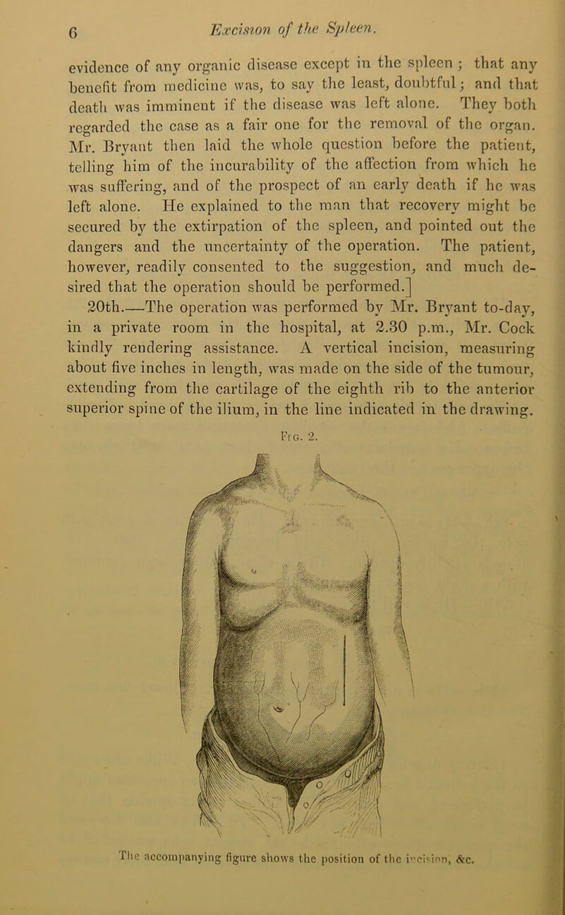 evidence of any organic disease except in the spleen ; that any benefit from medicine was, to say the least, doubtful; and that death was imminent if the disease was left alone. They both regarded the case as a fair one for the removal of the organ. Mr. Bryant then laid the whole question before the patient, telling him of the incurability of the affection from which he was suffering, and of the prospect of an early death if he was left alone. He explained to the man that recovery might be secured by the extirpation of the spleen, and pointed out the dangers and the uncertainty of the operation. The patient, however, readily consented to the suggestion, and much de- sired that the operation should be performed.] 20th.—The operation was performed by Mr. Bryant to-day, in a private room in the hospital, at 2.30 p.m., Mr. Cock kindly rendering assistance. A vertical incision, measuring about five inches in length, was made on the side of the tumour, extending from the cartilage of the eighth rib to the anterior superior spine of the ilium, in the line indicated in the drawing. Fig. 2. The accompanying figure shows the position of the i”oisinn, Sic.