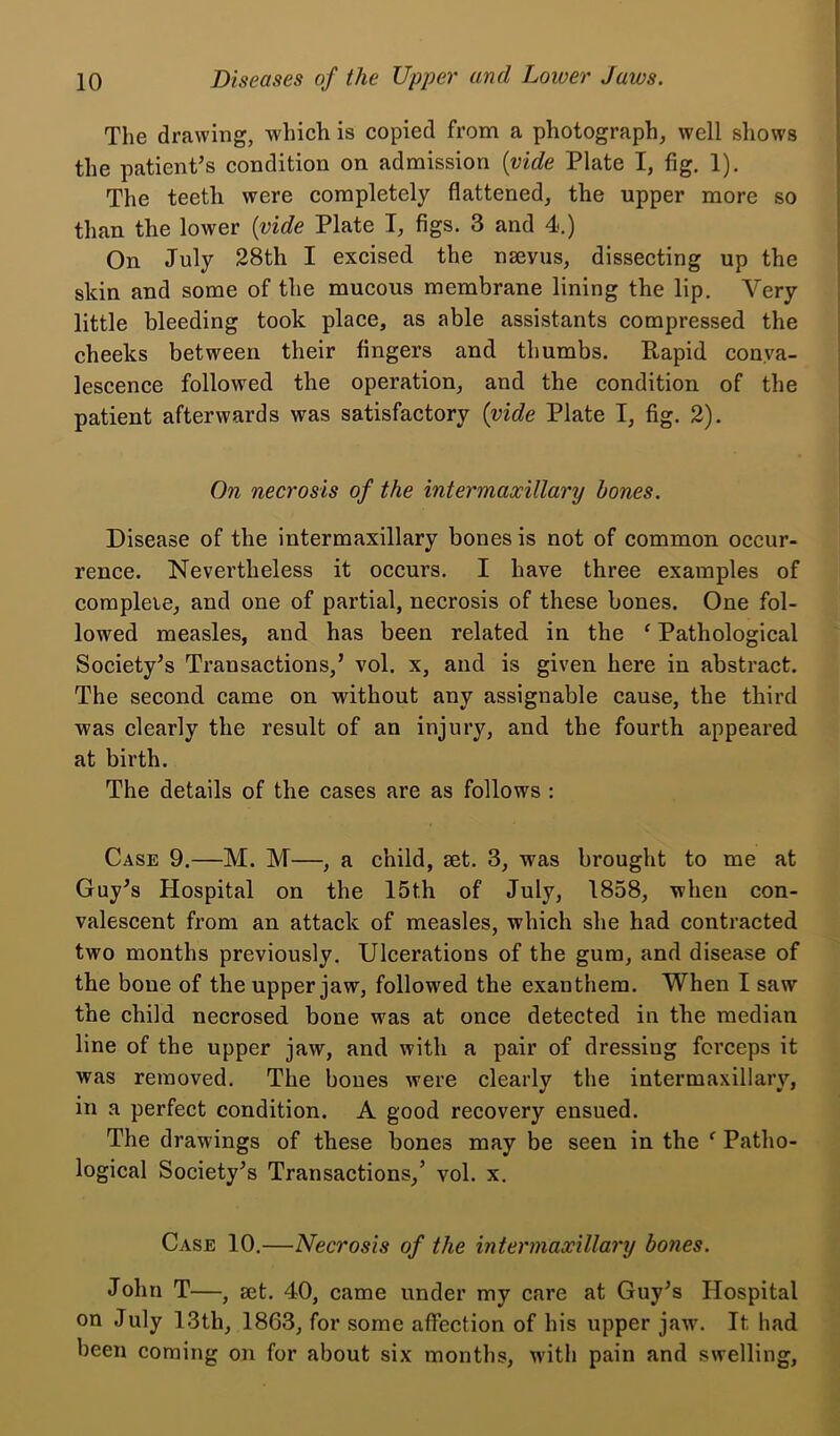 The drawing, which is copied from a photograph, well shows the patient’s condition on admission {vide Plate I, fig. 1). The teeth were completely flattened, the upper more so than the lower {vide Plate I, figs. 3 and 4.) On July 28th I excised the nsevus, dissecting up the skin and some of the mucous membrane lining the lip. Very little bleeding took place, as able assistants compressed the cheeks between their fingers and thumbs. Rapid conva- lescence followed the operation, and the condition of the patient afterwards was satisfactory {vide Plate I, fig. 2). On necrosis of the intermaxillary hones. Disease of the intermaxillary bones is not of common occur- rence. Nevertheless it occurs. I have three examples of compleie, and one of partial, necrosis of these bones. One fol- lowed measles, and has been related in the ‘ Pathological Society’s Transactions,’ vol. x, and is given here in abstract. The second came on without any assignable cause, the third was clearly the result of an injury, and the fourth appeared at birth. The details of the cases are as follows : Case 9.—M. M—, a child, set. 3, was brought to me at Guy’s Hospital on the 15th of July, 1858, when con- valescent from an attack of measles, which she had contracted two months previously. Ulcerations of the gum, and disease of the bone of the upper jaw, followed the exanthem. When I saw the child necrosed bone was at once detected in the median line of the upper jaw, and with a pair of dressing forceps it was removed. The bones were clearly the intermaxillaiy, in a perfect condition. A good recovery ensued. The drawings of these bones may be seen in the ^ Patho- logical Society’s Transactions,’ vol. x. Case 10.—Necrosis of the intermaxillary bones. John T—, set. 40, came under my care at Guy’s Hospital on July 13th, 1863, for some affection of his upper jaw\ It had been coming on for about six months, w'itlj pain and swelling,