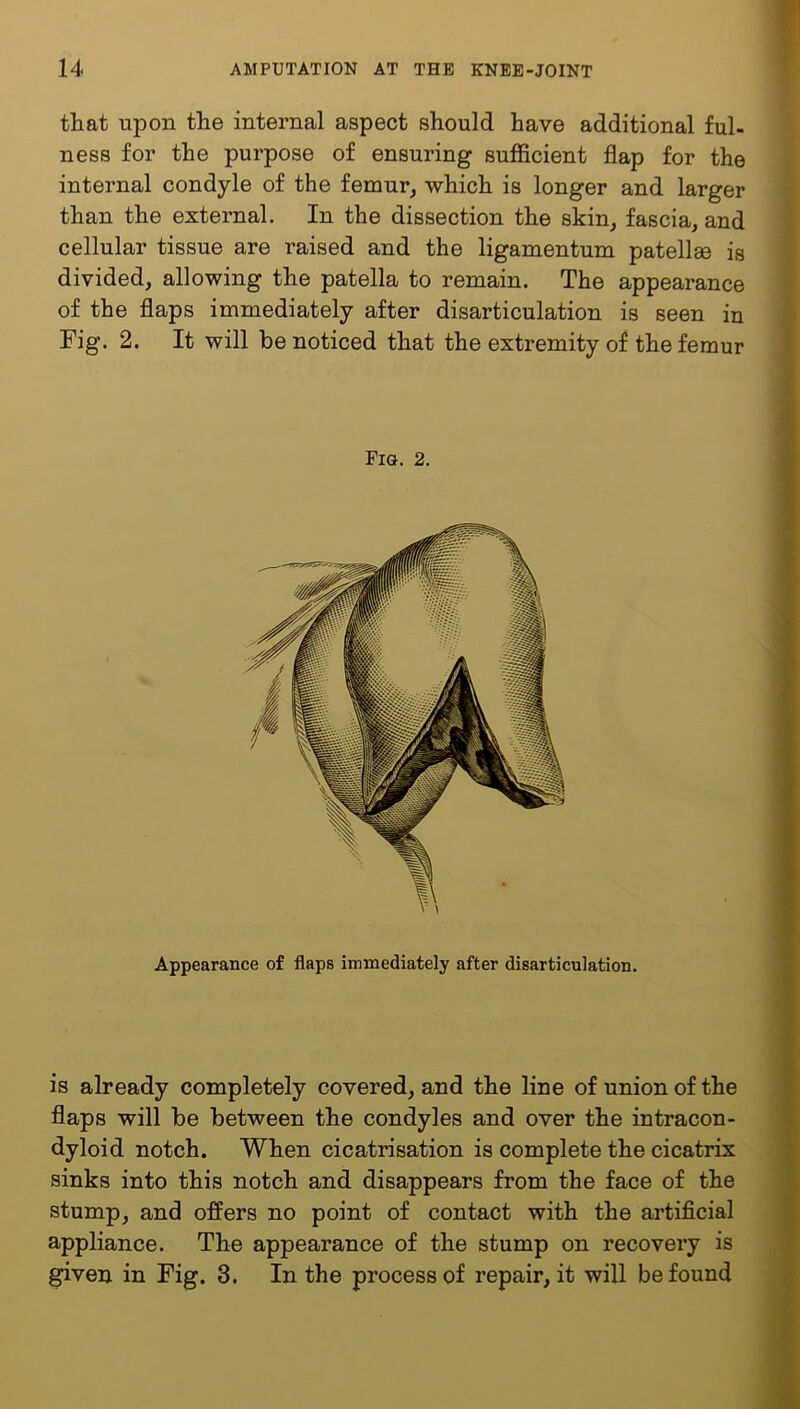 that upon the internal aspect should have additional ful- ness for the purpose of ensuring sufficient flap for the internal condyle of the femur, which is longer and larger than the external. In the dissection the skin, fascia, and cellular tissue are raised and the ligamentum patellse is divided, allowing the patella to remain. The appearance of the flaps immediately after disarticulation is seen in Fig. 2. It will be noticed that the extremity of the femur Fia. 2. Appearance of flaps immediately after disarticulation. is already completely covered, and the line of union of the flaps will be between the condyles and over the intracon- dyloid notch. When cicatrisation is complete the cicatrix sinks into this notch and disappears from the face of the stump, and offers no point of contact with the artificial appliance. The appearance of the stump on recovery is given in Fig. 3. In the process of repair, it will be found