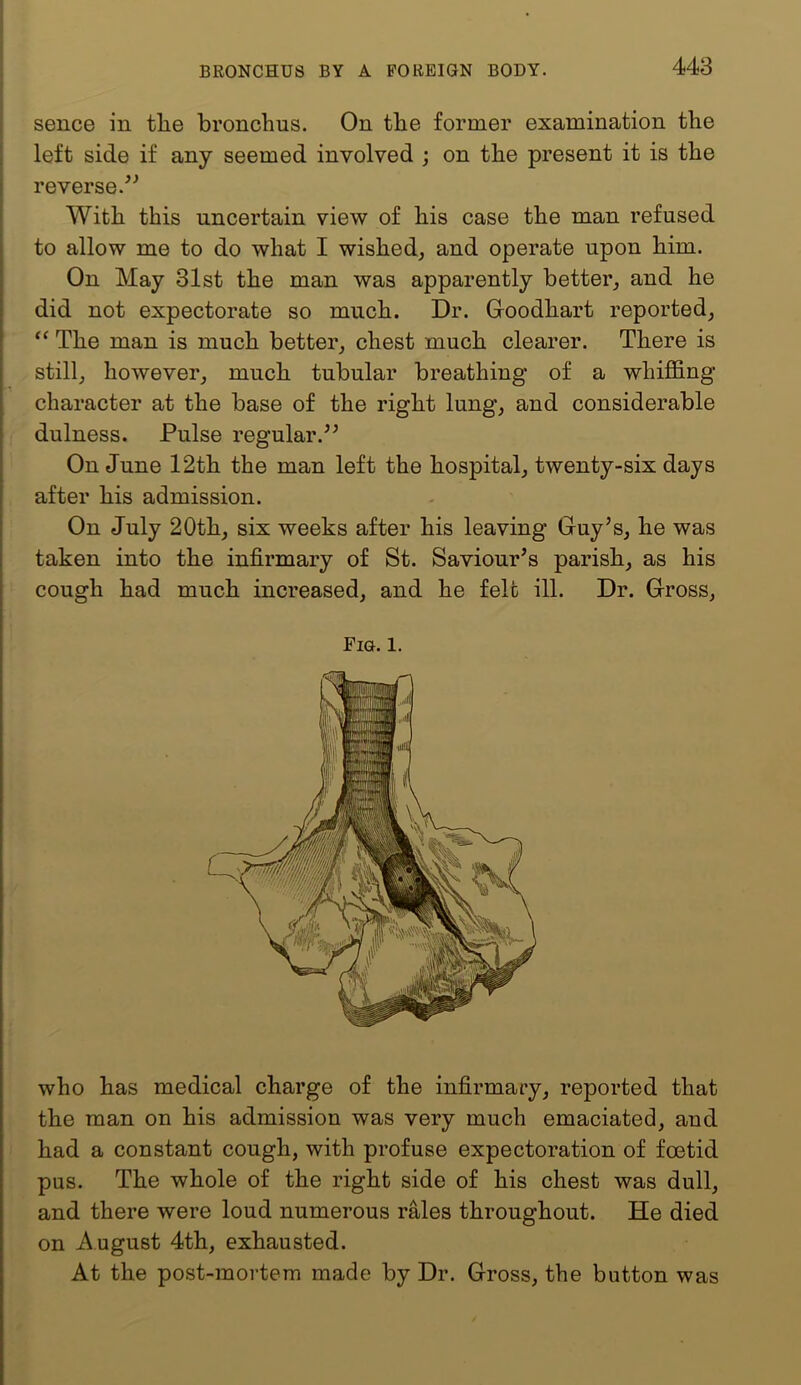 sence in tlie bronchus. On the former examination the left side if any seemed involved ; on the present it is the reverse.^’ With this uncertain view of his case the man refused to allow me to do what I wished, and operate upon him. On May 31st the man was apparently better, and he did not expectorate so much. Dr. Groodhart reported. The man is much better, chest much clearer. There is still, however, much tubular breathing of a whiffing character at the base of the right lung, and considerable : dulness. Pulse regular.^’ On June 12th the man left the hospital, twenty-six days after his admission. On July 20th, six weeks after his leaving Guy’s, he was taken into the infirmary of St. Saviour’s parish, as his cough had much increased, and he felt ill. Dr. Gross, Fig. 1. who has medical charge of the infirmary, reported that the man on his admission was very much emaciated, and I had a constant cough, with profuse expectoration of foetid pus. The whole of the right side of his chest was dull, and there were loud numerous rMes throughout. He died on August 4th, exhausted. At the post-mortem made by Dr. Gross, the button was