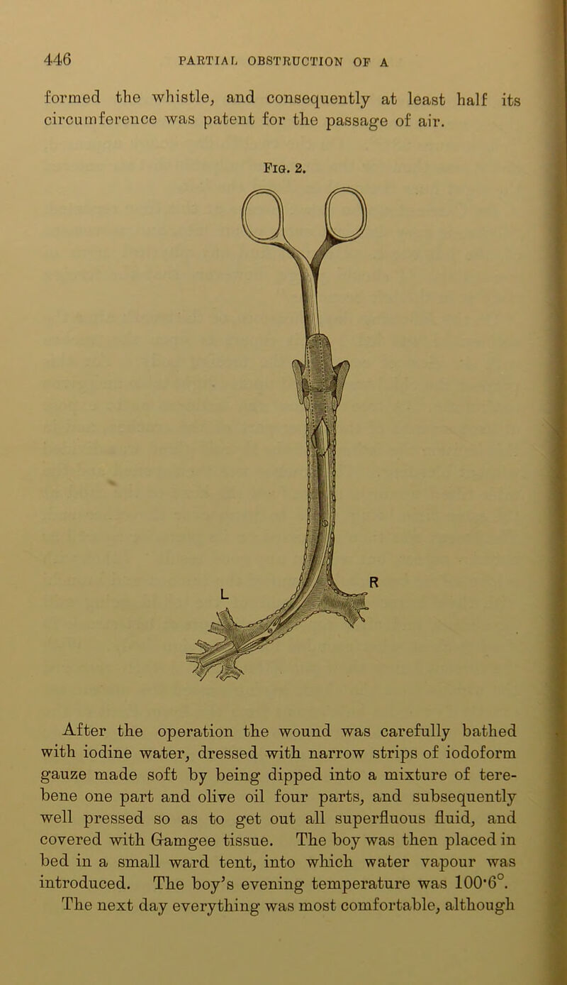 formed the whistle, and consequently at least half its circumference was patent for the passage of air. Fig. 2. After the operation the wound was carefully bathed with iodine water, dressed with narrow strips of iodoform gauze made soft by being dipped into a mixture of tere- bene one part and olive oil four parts, and subsequently well pressed so as to get out all superfluous fluid, and covered with Gamgee tissue. The boy was then placed in bed in a small ward tent, into which water vapour was introduced. The boy^s evening temperature was 100’6°. The next day everything was most comfortable, although