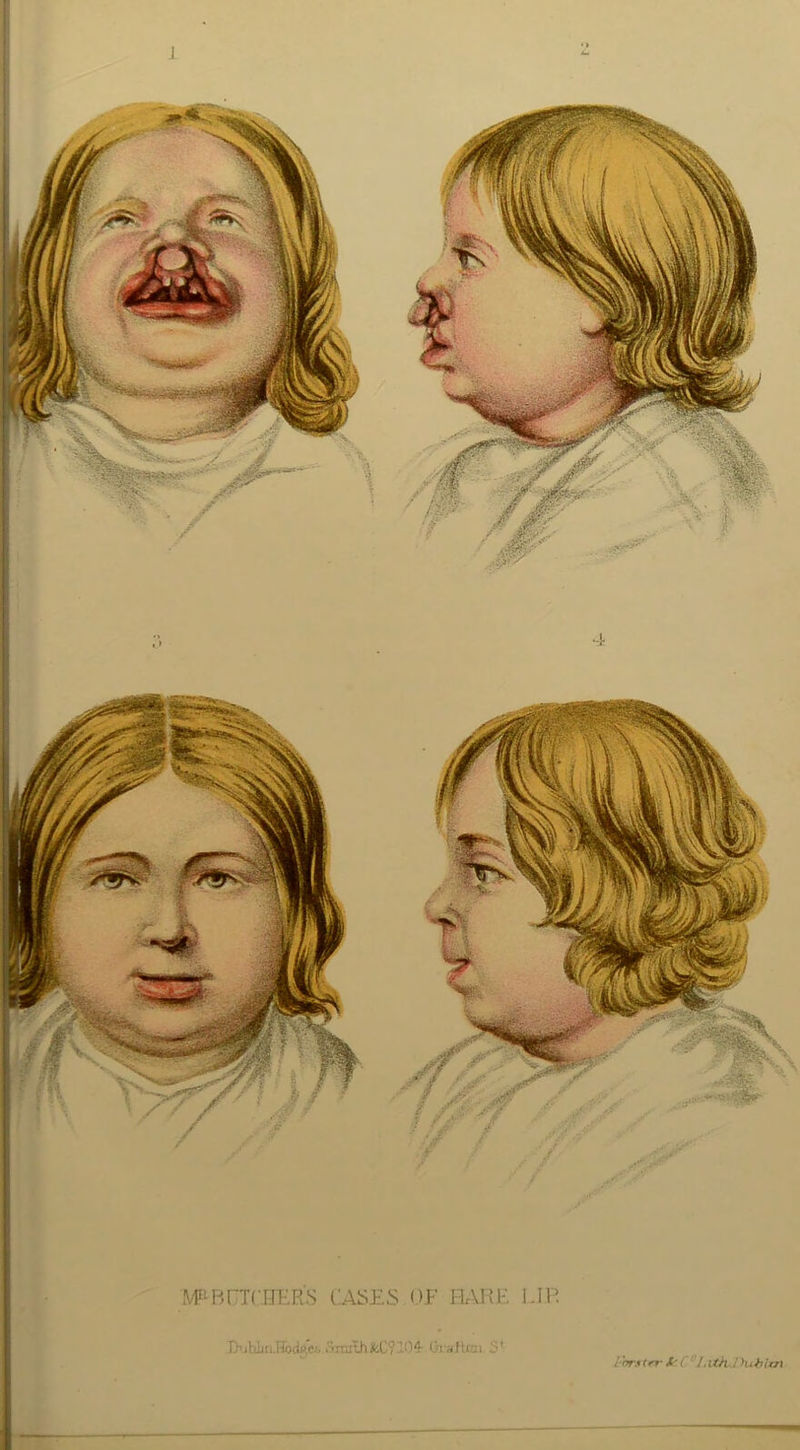 1 4 M^BPTCJIER'S CASES OE HARE LIP Duhlm.HodAt. SnuLh feC? 104 G-i afkm S1 i'rrr.% (rr &■('/. ithj hth Izn