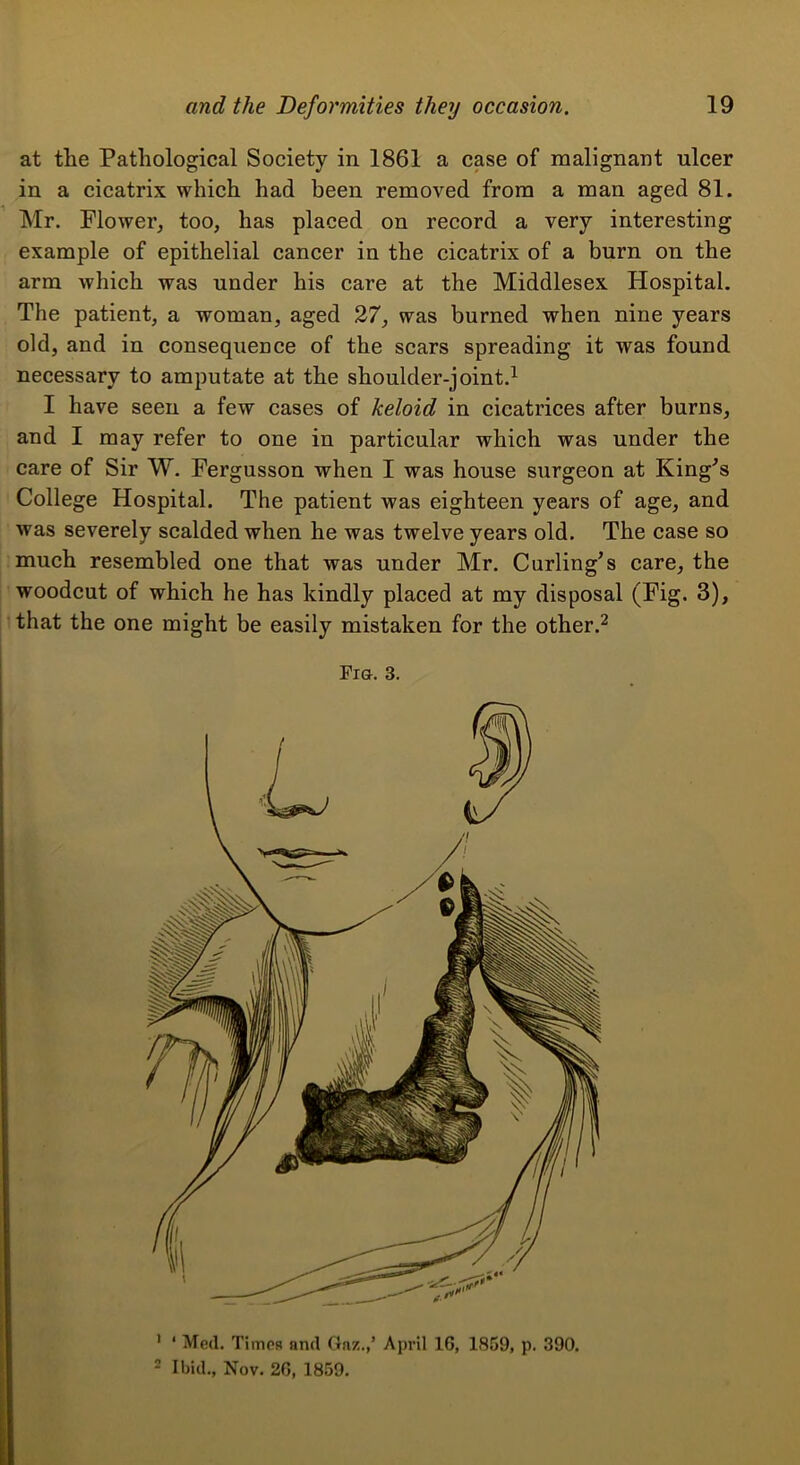 at the Pathological Society in 1861 a case of malignant ulcer in a cicatrix which had been removed from a man aged 81. Mr. Flower, too, has placed on record a very interesting example of epithelial cancer in the cicatrix of a burn on the arm which was under his care at the Middlesex Hospital. The patient, a woman, aged 27, was burned when nine years old, and in consequence of the scars spreading it was found necessary to amputate at the shoulder-joint. I have seen a few cases of keloid in cicatrices after burns, and I may refer to one in particular which was under the care of Sir W. Fergusson when I was house surgeon at King^s College Hospital. The patient was eighteen years of age, and was severely scalded when he was twelve years old. The case so much resembled one that was under Mr. Carling^s care, the woodcut of which he has kindly placed at my disposal (Fig. 3), that the one might be easily mistaken for the other.^ Fia. 3. ' ‘ Med. Times and Gnz.,’ April 16, 1859, p. 390. 2 Ibid., Nov. 26, 1859.