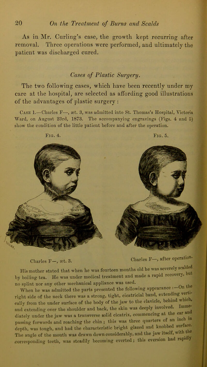 As in Mr. Curling’s case, the growth kept recurring after removal. Three operations were performed, and ultimately the patient was discharged cured. Cases of Plastic Surgery. The two following cases, whieh have been recently under my care at the hospital, are selected as affording good illustrations of the advantages of plastie surgery : Case 1.—Charles F—, set. 3, was admitted into St. Thomas’s Hospital, Victoria Ward, on August 23rd, 1873. The accompanying engravings (Figs. 4 and 5) show the condition of the little patient before and after the operation. Fiu. 4. Fig. 5. Charles F-, set. 3. Charles F—, after operation- His mother stated that when he was fourteen months old he was severely by boiling tea. He was under medical treatment and made a rapid recovery, n i no splint nor any other mechanical appliance was used. n tl e When he was admitted the parts presented the following appearance n j right side of the neck there was a strong, tight, cicatricial band, extending | cally from the under surface of the body of the jaw to the clavide, behind whic , ^ and extending over the shoulder and back, the skin was deeply invohed. Im | diately under the jaw was a transverse solid cicatrix, commencing at the | passing forwards and reaching the chin ; this was three qiiai tors of an inc | depth, was tough, and had the characteristic bright glazed and knobbed siir aeft | The angle of the mouth was drawn down considerably, and the jaw itself, wit i 'C | corresponding teeth, was steadily becoming everted; this eversion had rap 7 || I