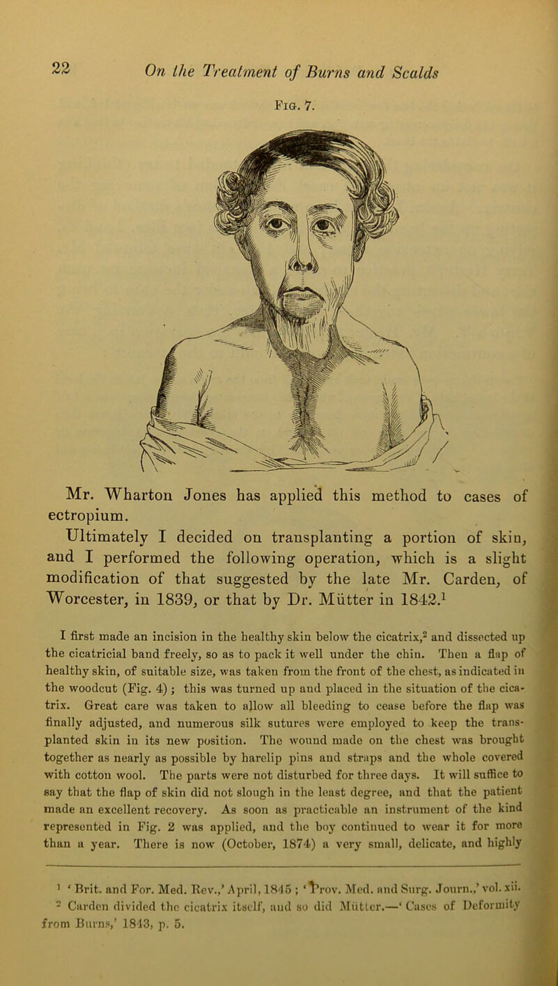 Fio-. 7. Mr. Wharton Jones has applied this method to cases of ectropium. Ultimately I decided on transplanting a portion of skin, and I performed the following operation, which is a slight modification of that suggested by the late Mr. Carden, of Worcester, in 1839, or that by Dr. Mutter in 1842.^ I first made an incision in the healthy skin below the cicatrix,^ and dissected up the cicatricial band freely, so as to pack it well under the chin. Then a flap of healthy skin, of suitable size, was taken from the front of the chest, as indicated in the woodcut (Fig. 4) ; this was turned up and placed in the situation of the cica- trix. Great care was taken to allow all bleeding to cease before the flap was finally adjusted, and numerous silk sutures were employed to keep the trans- planted skin in its new position. The wound made on the chest was brought together as nearly as possible by harelip pins and straps and the whole covered with cotton wool. The parts were not disturbed for three days. It will suffice to say that the flap of skin did not slough in the least degree, and that the patient made an excellent recovery. As soon as practicable an instrument of the kind represented in Fig. 2 was applied, and the boy continued to wear it for more than a year. There is now (October, 1874) a very small, delicate, and highly ’ ‘ Brit, and For. Med. Rev.,’April, 1845 ; ‘1’rov. Med. and Surg. .lourn.,’vol.xii. * Carden divided the cicatrix itself, aud so did ^liitlcr.—‘ Cases of Deformity from Burns,’ 1843, p. 5.
