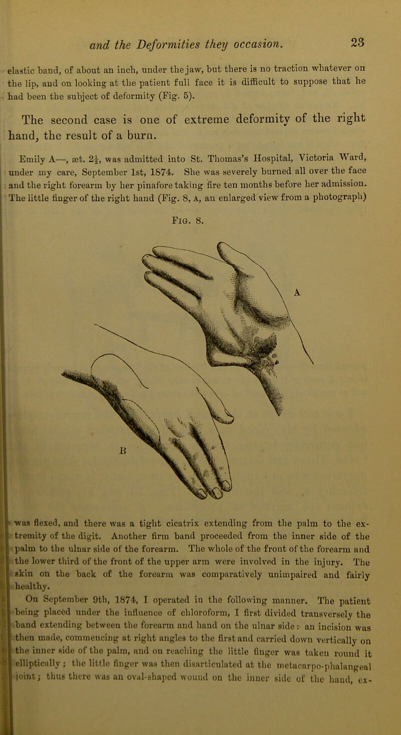 elastic band, of about an inch, under the jaw, but there is no traction whatever on the lip, and on looking at the patient full face it is difficult to suppose that he 1 had been the subject of deformity (Fig. 5). The second case is one of extreme deformity of the right hand, the result of a burn. Emily A—, set. 2^, was admitted into St. Thomas’s Hospital, Victoria Ward, under my care, September 1st, 1S74. She was severely burned all over the face : and the right forearm by her pinafore taking fire ten months before her admission. The little finger of the right hand (Fig. 8, A, an enlarged view from a photograph) Fig. 8. was flexed, and there was a tight cicatrix extending from the palm to the ex- I' tremity of the digit. Another firm band proceeded from the inner side of the palm to the ulnar side of the forearm. The whole of the front of the forearm and the lower third of the front of the upper arm were involved in the injury. The li skin on the back of the forearm was comparatively unimpaired and fairly - healthy. On September 9tb, 1874, I operated in the following manner. The patient being placed under the influence of chloroform, I first divided transversely the band extending between the forearm and hand on the ulnar side: an incision was then made, commencing at right angles to the first and carried down vertically on the inner side of the palm, and on reaching the little finger was taken round it elliptically ; the little finger was then disarticulated at the nietacarpo-phalangeal joint j thus there was an oval-shaped wound on the inner side of the hand, ex-