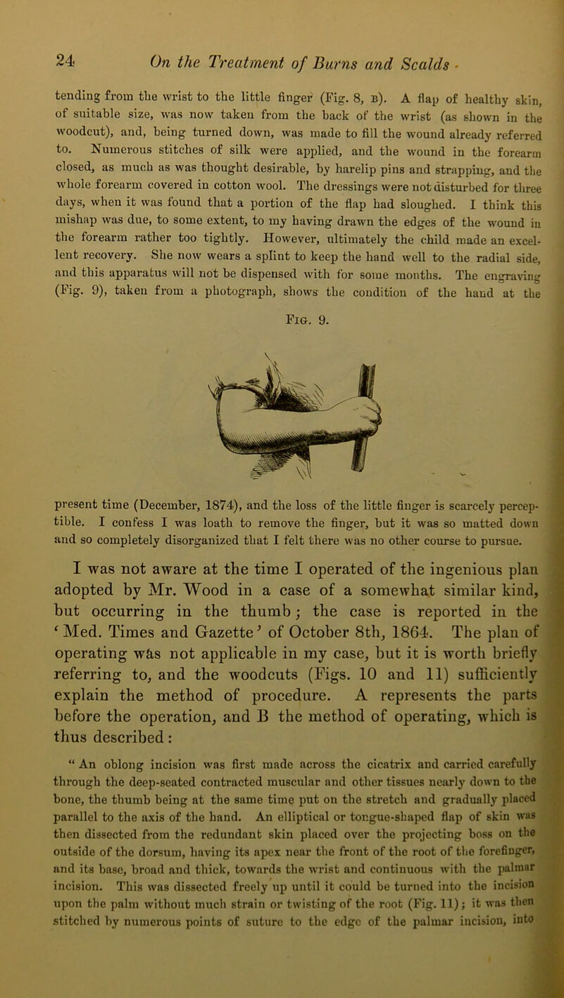 tending from the wrist to the little finger (Fig. 8, b). A flap of healthy skin, of suitable size, was now taken from the back of the wrist (as shown in the woodcut), and, being turned down, was made to fill the wound already referred to. Numerous stitches of silk were applied, and the wound in the forearm closed, as much as was thought desirable, by harelip pins and strapping, and the whole forearm covered in cotton wool. The dressings were not disturbed for three days, when it was found that a portion of the flap had sloughed. I think this mishap was due, to some extent, to my having drawn the edges of the wound in the forearm rather too tightly. However, ultimately the child made an excel- lent recovery. She now wears a splint to keep the hand well to the radial side, and this apparatus will not he dispensed with for some months. The engraving (Fig. 9), taken from a photograph, shows the condition of the hand at the Fig. 9. \ present time (December, 1874), and the loss of the little finger is scarcely percep- tible. I confess I was loath to remove the finger, hut it was so matted down and so completely disorganized that I felt there was no other course to pursue. I was not aware at the time I operated of the ingenious plan adopted by Mr. Wood in a case of a somewhat similar kind, but occurring in the thumb; the case is reported in the ‘ Med. Times and Gazette ^ of October 8th, 1864. The plan of operating w&s not applicable in my case, but it is worth briefly referring to, and the woodcuts (Pigs. 10 and 11) sufficiently explain the method of procedure. A represents the parts before the operation, and B the method of operating, which is thus described: “ An oblong incision was first made across the cicatrix and carried carefully through the deep-seated contraeted muscular and other tissues nearly down to the hone, the thumb being at the same time put on the stretch and gradually placed parallel to the axis of the hand. An elliptieal or tongue-shaped flap of skin was then dissected from the redundant skin placed over the projecting boss on the outside of the dorsum, having its apex near the front of the root of the forefinger, and its base, broad and thick, towards the wrist and continuous with the palmar incision. This was dissected freely up until it could be turned into the incision upon the palm without much strain or twisting of the root (Fig. 11); it was then stitched by numerous points of suture to the edge of the palmar incision, into