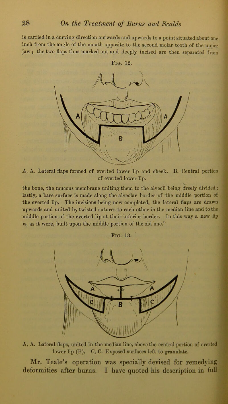 is carried in a curving direction outwards and upwards to a point situated about one inch from the angle of the mouth opposite to the second molar tooth of the upper jaw; the two flaps thus marked out and deeply incised are then separated from Fia. 12. A, A. Lateral flaps formed of everted lower lip and cheek. B. Central portion of everted lower lip. the hone, the mucous membrane uniting them to the alveoli being freely divided; lastly, a bare surface is made along the alveolar border of the middle portion of the everted lip. The incisions being now completed, the lateral flaps are drawn upwards and united by twisted sutures to each other in the median line and to the middle portion of the everted lip at their inferior border. In this way a new lip is, as it were, built upon the middle portion of the old one.” Fig. 13. A, A. Lateral flaps, united in the median line, above the central portion of everted lower lip (B). C, C. Exposed surfaces left to granulate. Mr. Teale’s operation was specially devised for remedying deformities after burns. I have quoted his description in full