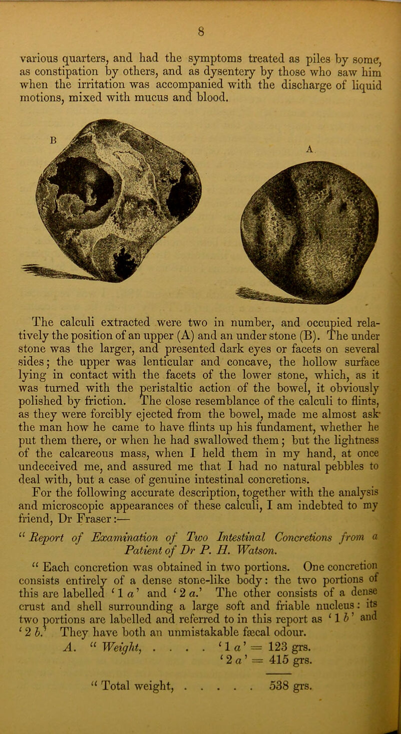 various quarters, and had the symptoms treated as piles by some, as constipation by others, and as dysentery by those who saw him when the irritation was accompanied with the discharge of liquid motions, mixed with mucus and blood. The calculi extracted were two in number, and occupied rela- tively the position of an upper (A) and an under stone (B). The under stone was the larger, and presented dark eyes or facets on several sides; the upper was lenticular and concave, the hollow surface lying in contact with the facets of the lower stone, which, as it was turned with the peristaltic action of the bowel, it obviously polished by friction. The close resemblance of the calculi to flints, as they were forcibly ejected from the bowel, made me almost ask- the man how he came to have flints up his fundament, whether he put them there, or when he had swallowed them; but the lightness of the calcareous mass, when I held them in my hand, at once undeceived me, and assured me that I had no natural pebbles to deal with, but a case of genuine intestinal concretions. For the following accurate description, together with the analysis and microscopic appearances of these calculi, I am indebted to my friend, Dr Fraser:— u Report of Examination of Two Intestinal Concretions from a Patient of Dr P. II. Watson. 11 Each concretion was obtained in two portions. One concretion consists entirely of a dense stone-like body: the two portions of this are labelled ‘la’ and 1 2 al The other consists of a dense crust and shell surrounding a large soft and friable nucleus: its two portions are labelled and referred to in this report as 11 b ’ and 1 2 bl They have both an unmistakable fmcal odour. A. “ Weight, .... ‘la’=123 grs. ‘2 a ’ = 415 grs. “ Total weight, . . 538 grs.