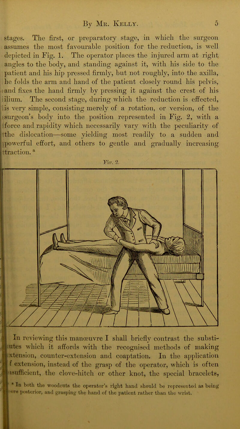 stages. The first, or preparatory stage, in which the surgeon assumes the most favourable position for the reduction, is well depicted in Fig. 1. The operator places the injured arm at right, angles to the body, and standing against it, with his side to the patient and his hip pressed firmly, but not roughly, into the axilla, he folds the arm and hand of the patient closely round his pelvis, . and fixes the hand firmly by pressing it against the crest of his i ilium. The second stage, during which the reduction is effected, is very simple, consisting merely of a rotation, or version, of the fsurgeon’s body into the position represented in Fig. 2, with a : force and rapidity which necessarily vary with the peculiarity of ^the dislocation—some yielding most readily to a sudden and i'lpowerful effort, and others to gentle and gradually increasing Attraction. In reviewing this manmuvre I shall briefly contrast the substi- liites which it affords with the recognised methods of making xtension, counter-extension and coaptation. In the application f extension, instead of the grasp of the operator, which is often •isufflcient, the clove-hitch or other knot, the special bracelets, In both the wooclcutH the operator’s right hand should be represented as being ore posterior, and grasping the hand of the patient rather than the wrist.