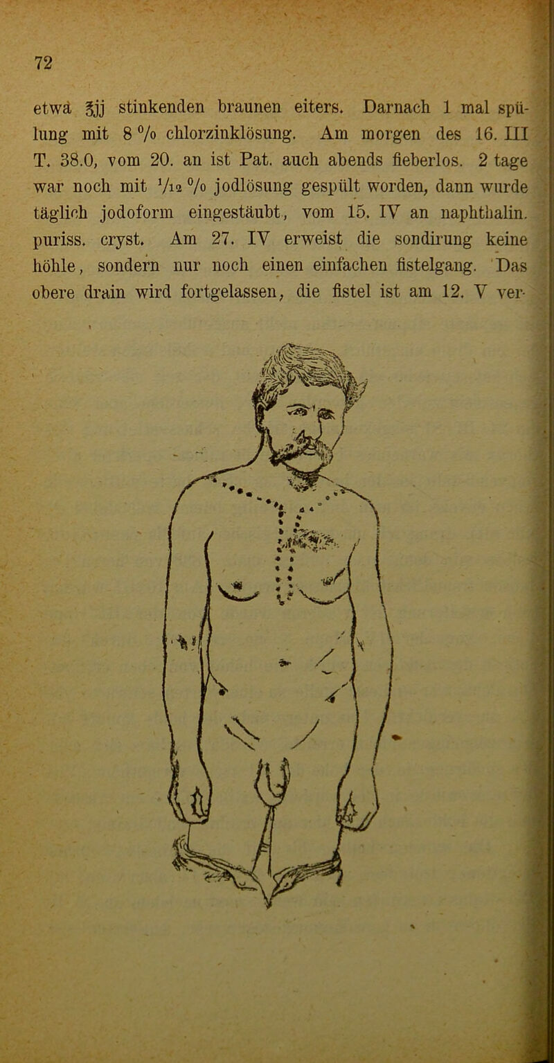 etwa 3jj stinkenden braunen eiters. Darnach 1 mal spü- lang mit 8 % chlorzinklösung. Am morgen des 16. III * T. 38.0, vom 20. an ist Pat. auch abends fieberlos. 2 tage war noch mit °/o jodlösung gespült worden, dann wurde täglich jodoform eingestäubt, vom 15. IV an naphthalin. puriss. cryst. Am 27. IV erweist die sondirung keine höhle, sondern nur noch einen einfachen fistelgang. Das obere drain wird fortgelassen, die fistel ist am 12. V ver-