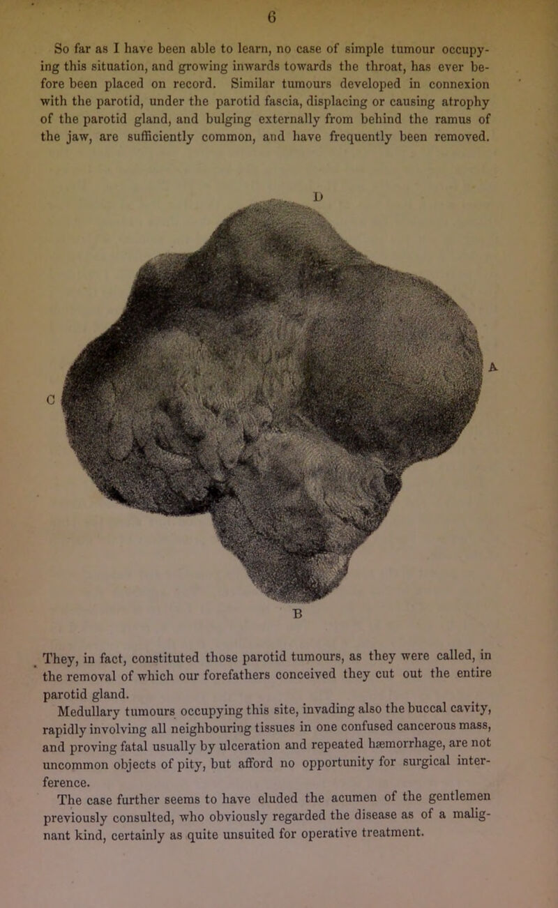 So far as I have been able to learn, no case of simple tumour occupy- ing this situation, and growing inwards towards the throat, has ever be- fore been placed on record. Similar tumours developed in connexion with the parotid, under the parotid fascia, displacing or causing atrophy of the parotid gland, and bulging externally from behind the ramus of the jaw, are sufficiently common, and have frequently been removed. They, in fact, constituted those parotid tumours, as they were called, in the removal of which our forefathers conceived they cut out the entire parotid gland. Medullary tumours occupying this site, invading also the buccal cavity, rapidly involving all neighbouring tissues in one confused cancerous mass, and proving fatal usually by ulceration and repeated haemorrhage, are not uncommon objects of pity, but afford no opportunity for surgical inter- ference. The case further seems to have eluded the acumen of the gentlemen previously consulted, who obviously regarded the disease as of a malig- nant kind, certainly as quite unsuited for operative treatment.
