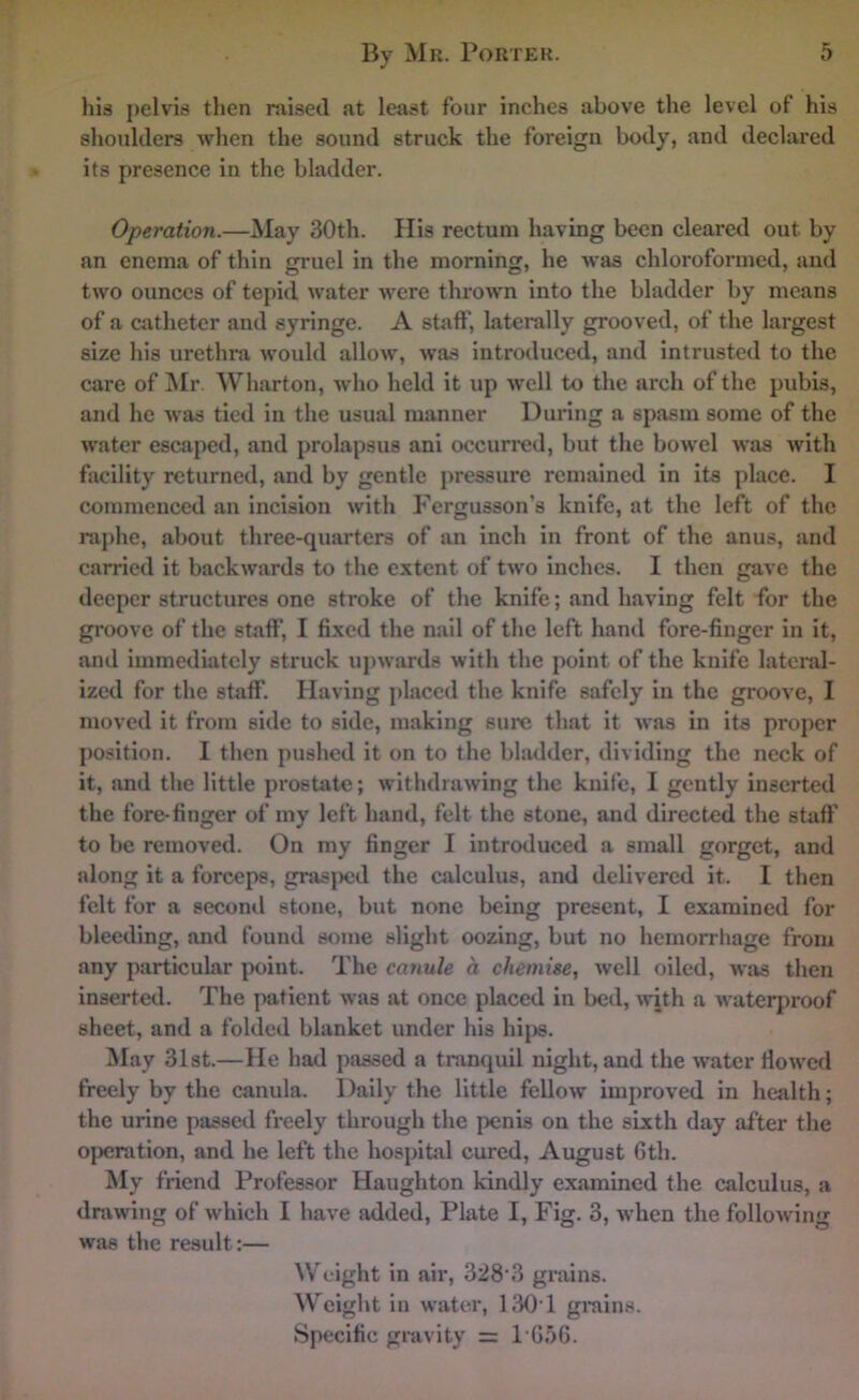 his pelvis then raised at least four inches above the level of his shoulders when the sound struck the foreign body, and declared its presence in the bladder. Operation.—May 30th. Ilis rectum having been cleared out by an enema of thin gruel in the morning, he was chloroformed, and two ounces of tepid water were tlu’own into the bladder by means of a ciithetcr and syringe. A staff, laterally grooved, of the largest size his urethra would allow, was introduced, and intrusted to the care of ^Ir Wharton, who held it up well to the arch of the pubis, and he was tied in the usual manner During a spasm some of the water escaped, and prolapsus ani occurred, but the bowel was with facility returned, and by gentle pressure remained in its place. I commenced an incision with Fergusson’s knife, at the left of the raj)he, about three-quarters of an inch in front of the anus, and carried it backwards to the extent of two inches. I then gave the deeper structures one stroke of the knife; and having felt for the groove of the staff, I fixed the nail of the left hand fore-finger in it, and immediately struck upwards with the point of the knife lateral- ized for the staff. Having placed the knife safely in the groove, I moved it from side to side, making sure that it was in its proper position, I then pushed it on to the bladder, dividing the neck of it, and the little prostate; withdrawing the knife, I gently inserted the fore-finger of my left hand, felt the stone, and directed the staff to be removed. On my finger I introduced a small gorget, and along it a forceps, grasjKjd the calculus, and delivered it. I then felt for a second stone, but none being present, I examined for bleeding, and found some slight oozing, but no hemorrliage from any particular point. The cajiule a chemise, well oiled, was then inserted. The jiatient was at once placed in bed, Avith a waterproof sheet, and a folded blanket under his hijrs. May 31st.—He had passed a tranquil night, and the water fioAved freely by the canula. Dally the little fellow improved in health; the urine passed freely through the penis on the sixth day after the operation, and he left the hospital cured, August 6th. My friend Professor Haughton kindly examined the calculus, a drawing of which I haA'e added, Plate 1, Fig, 3, when the folloAving was the result:— Weight in air, 328'3 grains. Weight in water, 130T gi*ains. Specific gmvity = 1G5G.