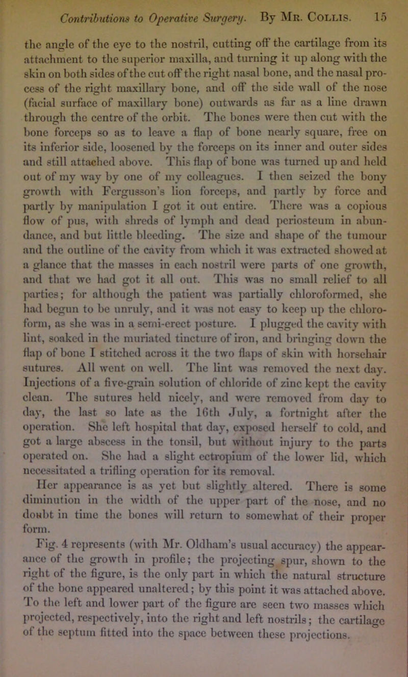the angle of the eye to the nostril, cutting off the cnrtilagc from its attachment to the superior maxilla, and turning it up along with the skin on both sides of the cut off the right nasal bone, and the nasal pro- cess of the right maxillary bone, and off the side wall of the nose (facial surface of maxillary bone) outwards as far as a line drawn through the centre of the orbit. The bones were then cut with the bone forceps so as to leave a flap of bone nearly square, free on its inferior side, loosened by the forceps on its inner and outer sides and still attached above. This flap of bone was turned up and held out of my way by one of my colleagues. I then seized the bony growth with Fergusson’s lion forceps, and partly by force and partly by manipulation I got it out entire. There was a copious flow of pus, with shreds of lymph and dead periosteum in abun- dance, and but little bleeding. The size and shape of the tumour and the outline of the cavity from which it was extracted showed at a glance that the masses in each nostril were parts of one growth, and that we had got it all out. This was no small relief to all parties; for although the patient was j)artially chlorofonned, she had begun to be unruly, and it A\*as not easy to keep up the chloro- form, as she was in a serni-crect i)05ture. I plugged the cavity with lint, soaked in the muriated tincture of iron, and bnnging down the flap of bone I stitched across it the two flaps of skin with horsehair sutures. All went ou well. The lint was removed the next day. Injections of a five-gmin solution of chloride of zinc kept the cavity clean. The sutures held nicely, and were removed from day to day, the last so late as the 16th July, a fortnight after the operation. She left hospital that day, exposed herself to cold, and got a large abscess in the tonsil, but without injury to the parts operated on. She had a slight cctropium of the lower lid, which necessitatwl a trifling operation for its removal. Her appearance is as yet but slightly altered. There is some diminution in the width of the upper part of the nose, and no doubt in time the bones will return to somewhat of their proper form. Fig. 4 represents (with JSIr. Oldham’s usual accuracy) the appear- ance of the growth in profile; the projecting spur, shoAvn to the right of the figure, is the only part in which the natural structure of the bone appeared unaltered; by this point it was attached above. To the left and lower part of the figure arc seen two masses which projected, respectively, into the right and left nostrils; the cartilage of the septum fitted into the space between these projections.