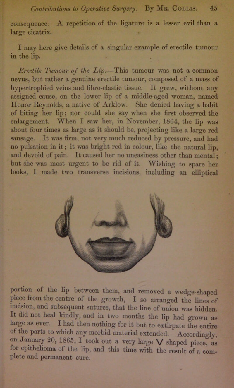 consequence. A repetition of the ligature is a lesser evil than a large cicatrix. I may here give details of a singular example of erectile tumour in the lip. Erectile Tumour of the Lip.—This tumour was not a common nevus, but rather a genuine erectile tumour, composed of a mass of hypertrophied veins and fibro-elastic tissue. It grew, without any assigned cause, on the lower lip of a middle-aged woman, named Honor Reynolds, a native of Arklow. She denied having a habit of biting her lip; nor could she say when she first observed the enlargement. When I saw her, in November, 1864, the lip was about four times as large as it should be, projecting like a large red sausage. It was firm, not very much reduced by pressure, and had no pulsation in it; it was bright red in colour, like the natural lip, and devoid of pain. It caused her no uneasiness other than mental; but she was most urgent to be rid of it. Wishing to spare her looks, I made two transverse incisions, including an elliptical portion of the lip between them, and removed a wedge-shaped piece from the centre of the growth, I so arranged the lines of incision, and subsequent sutures, that the line of union was hidden. It did not heal kindly, and in two months the lip had grown as large as ever. I had then nothing for it but to extirpate the entire of the parts to which any morbid material extended. Accordingly, on January 20, 1865, I took out a very large V shaped piece, as for epithelioma of the lip, and this time with the result of a com- plete and permanent cure.