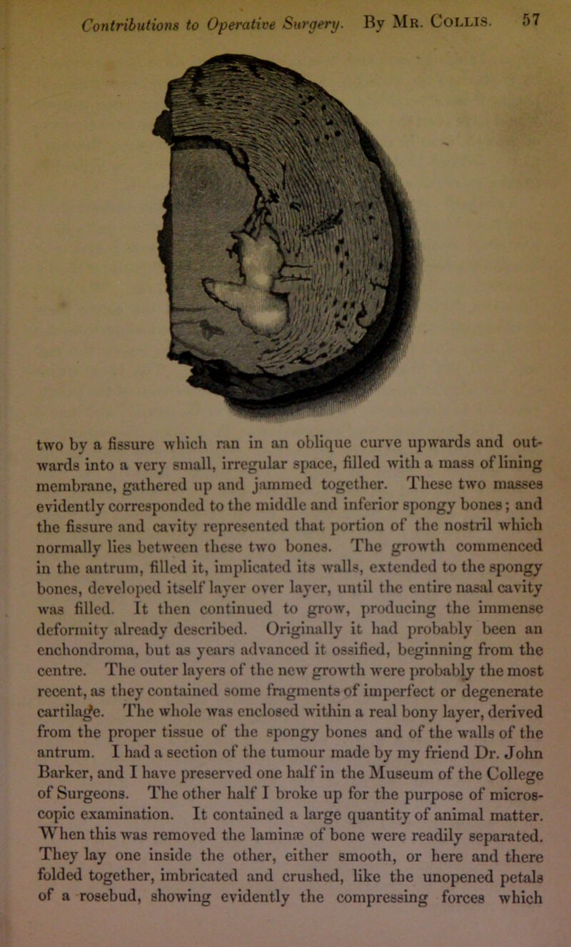 two by a fissure whicli ran in an oblique curve upwards and out- wards into a very small, irregular space, filled with a mass of lining membrane, gathered up and jammed together. These two masses evidently corresponded to the middle and inferior spongy bones; and the fissure and cavity represented that portion of the nostril which normally lies between these two bones. The growth commenced in the antrum, filled it, implicated its walls, extended to the spongy bones, developed itself layer over layer, until the entire nasal cavity was filled. It then continued to grow, producing the immense deformity already described. Originally it had probably been an enchondroma, but as years advanced it ossified, beginning from the centre. The outer layers of the new growth were probably the most recent, as they contained some fragments of imperfect or degenerate cartilage. The whole was enclosed within a real bony layer, derived from the proper tissue of the spongy bones and of the walls of the antrum. I had a section of the tumour made by my friend Dr, John Barker, and I have preserved one half in the Museum of the College of Surgeons. The other half I broke up for the purpose of micros- copic examination. It contained a large quantity of animal matter. When this was removed the laminas of bone were readily separated. They lay one Inside the other, either smooth, or here and there folded together, imbricated and crushed, like the unopened petals of a rosebud, showing evidently the compressing forces which