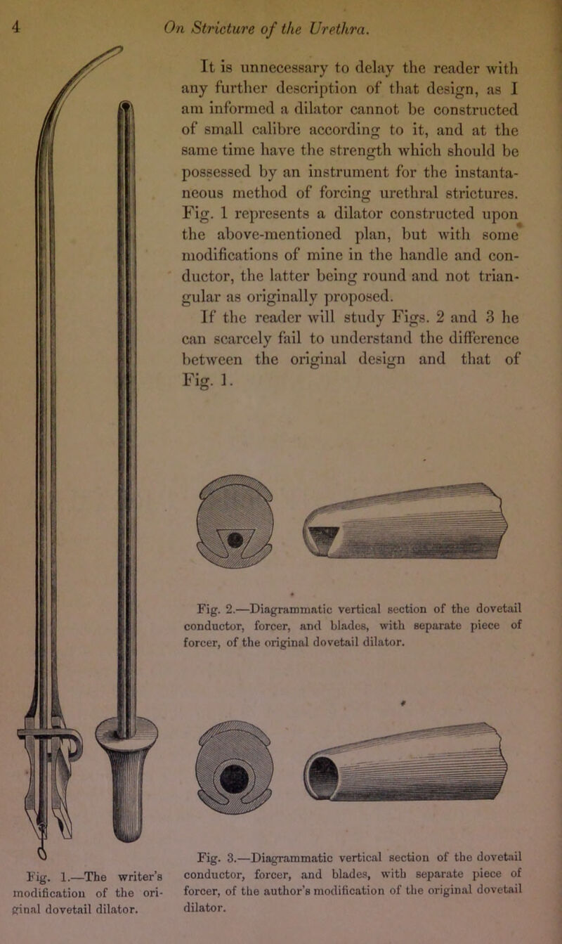 Fig. 1.—The writer’s modificatiou of the ori- ginal dovetail dilator. It is unnecessary to delay the reader with any further description of that design, as I am informed a dilator cannot be constructed of small calibre according to it, and at the same time have the strength which should be possessed by an instrument for the instanta- neous method of forcing urethral strictures. Fig. 1 represents a dilator constructed upon the above-mentioned plan, but with some modifications of mine in the handle and con- ductor, the latter being round and not trian- gular as originally proposed. If the reader will study Figs. 2 and 3 he can scarcely fail to understand the difi'crence between the original design and that of Fig. 1. Fig. 2.—Diagrammatic vertical section of the dovetail conductor, forcer, and blades, with separate piece of forcer, of the original dovetail dilator. Fig. 3.—Diagrammatic vertical secUon of the dovet;dl conductor, forcer, and blade.'i, with separate j)iece of forcer, of the author’s modification of the original dovetail dilator.