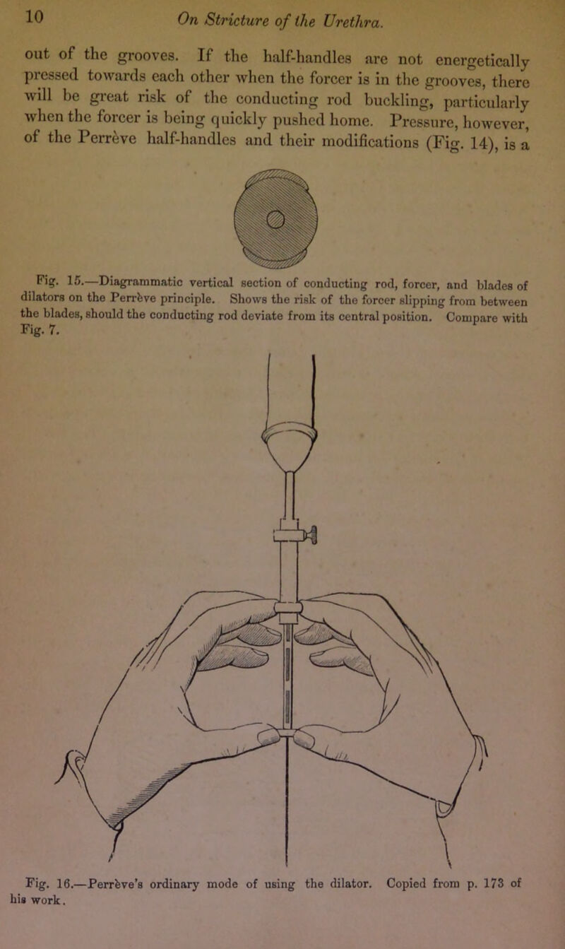 out of the grooves. If the half-handles are not energetically pressed towards each other when the forcer is in the grooves, there will be great risk of the conducting rod buckling, particularly when the forcer is being quickly pushed home. Pressure, however, of the Perreve half-handles and their modifications (Fig. 14), is a Fig. 15.—Diagrammatic vertical section of conducting rod, forcer, and blades of dilators on the Perrhve principle. Shows the risk of the forcer slipping from between the blades, should the conducting rod deviate from its central position. Compare with Fig. 7. Fig. 16.—Perrhve’s ordinary mode of using the dilator. Copied from p. 173 of his work.