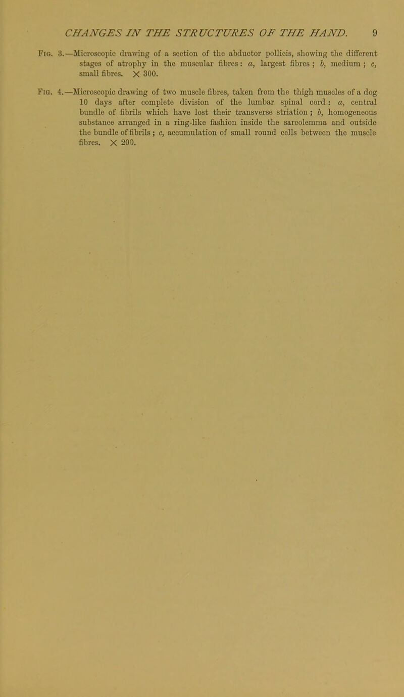 Fig. 3.—Microscopic drawing of a section of the abductor pollicis, showing the different stages of atrophy in the muscular fibres: a, largest fibres ; h, medium ; c, small fibres. X 300. Fig. 4.—Microscopic drawing of two muscle fibres, taken fi’om the thigh muscles of a dog 10 days after complete division of the lumbar spinal cord: a, central bundle of fibrils which have lost their ti’ansverse sti’iation; h, homogeneous substance arranged in a ring-like fashion inside the sarcolerama and outside the bundle of fibrils ; c, accumulation of small round cells between the muscle fibres. X 200.