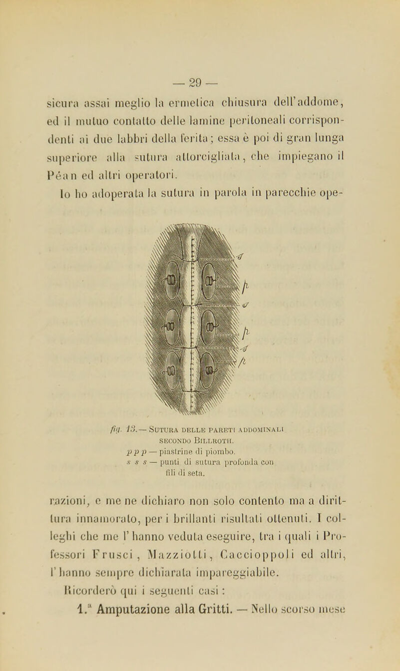 sicura assai meglio la ermelica cliiusiira dell’addome, ed il iiuiluo coniano delle lamine peritoneali corrispon- denti ai due labbri delia ferita; essa è poi di gran lunga superiore alla sutura alloi'eigliata, die impiegano il Péan ed altri operatori. lo bo adoperata la sutura in parola in pareccbie ope- lo.— Sutura delle pareti addominali SECONDO BiLLROTH. p p p — piasi ri ne di piombo. s s s — punti di sutura profonda con (ili ili seta. razioni, e me ne dichiaro non solo contento ma a dirit- tura innamoralo, peri brillanti risultali ottenuti. I col- leglli die me 1’ hanno veduta eseguire, tra i quali i Pro- fessori Frusci, Mazziotli, Caccioppoli ed altri, r hanno sempre dichiarala impareggiabile. Ilicorderò t[ui i seguenti casi ; Amputazione alla Gritti. — ÌNdlo scorso mese