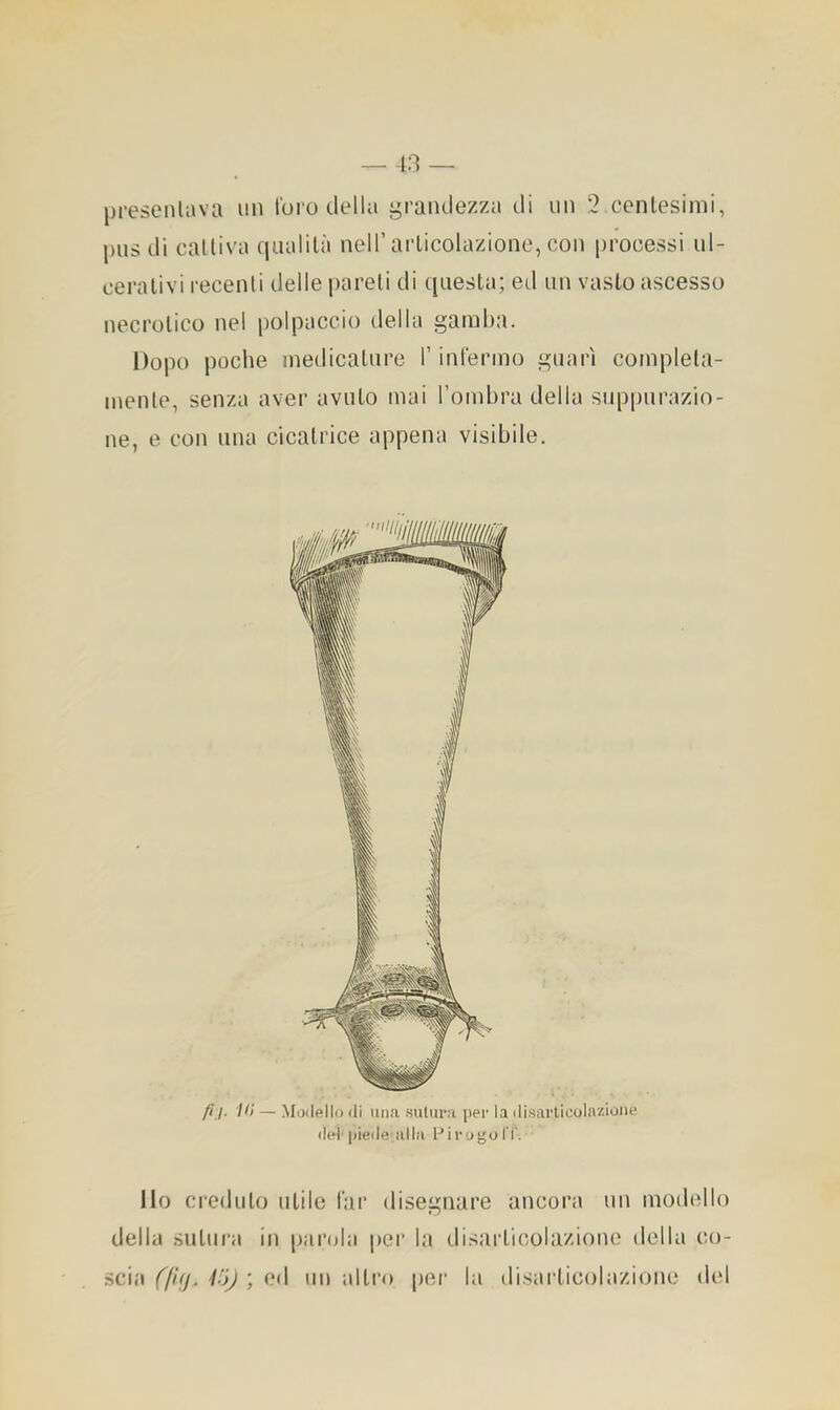 presentava un l'oro della i^raiulezza di un 2 centesimi, pus di cattiva qualità nell’articolazione, con processi ul- cerativi recenti delle pareti di questa; ed un vasto ascesso necrotico nel polpaccio della gamba. Dopo poche medicature l’infermo guarì compieta- mente, senza aver avuto mai Tombra della suppurazio- ne, e con una cicatrice appena visibile. ///. IH — Modello «li una sutura per la «lisarticolazione «l(*l piede alla Pirogal'I'. Ilo creduto utile far disegnare ancorti un moilello della sutura in parola per la disarticolazione della co- scia (fuj. Vi) ; od un altro per la disiirticobizione dt'l