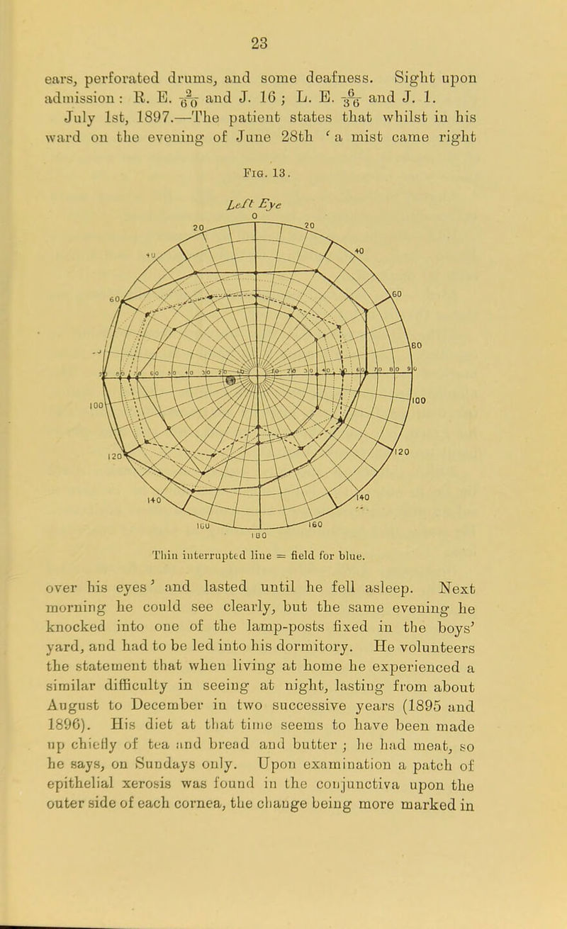 ears, perforated drums, and some deafness. Sight upon admission ; R. E. ^ and J. 16 ; L. E. 3-^ and J. 1. July 1st, 1897.—The patient states that whilst in his ward on the evening of June 28th ^a mist came right Fig. 13. Urt Eye 0 over his eyes ^ and lasted until he fell asleep. Next morning he could see clearly, but the same evening he knocked into one of the lamp-posts fixed in tlie boys’ yard, and had to be led into his dormitory. He volunteers the statement that when living at home he experienced a similar difficulty in seeing at night, lasting from about August to December in two successive years (1895 and 1896). His diet at that time seems to have been made up chieHy of tea and broad and butter ; he had meat, so he says, on Sundays only. Upon examination a patch of epithelial xerosis was found in the conjunctiva upon the outer side of each cornea, the change being more marked in